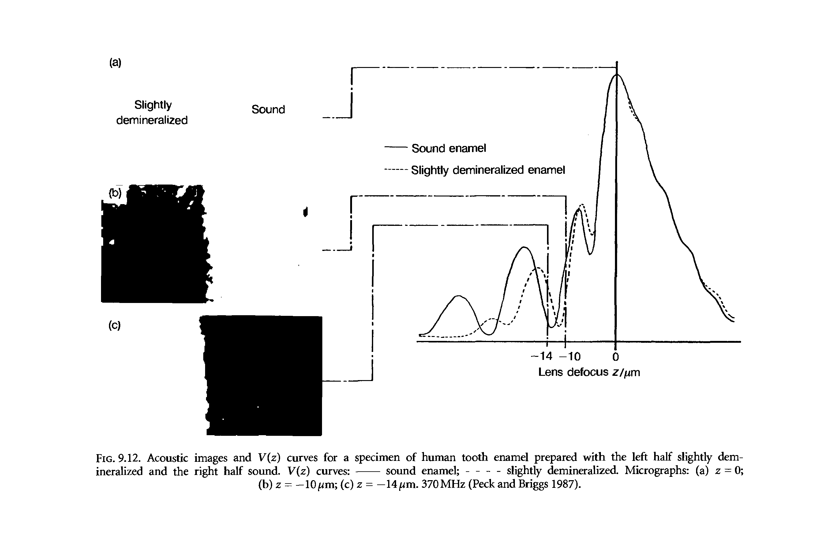 Fig. 9.12. Acoustic images and V(z) curves for a specimen of human tooth enamel prepared with the left half slightly demineralized and the right half sound. V(z) curves ---- sound enamel - - - - slightly demineralized. Micrographs (a) z = 0 ...