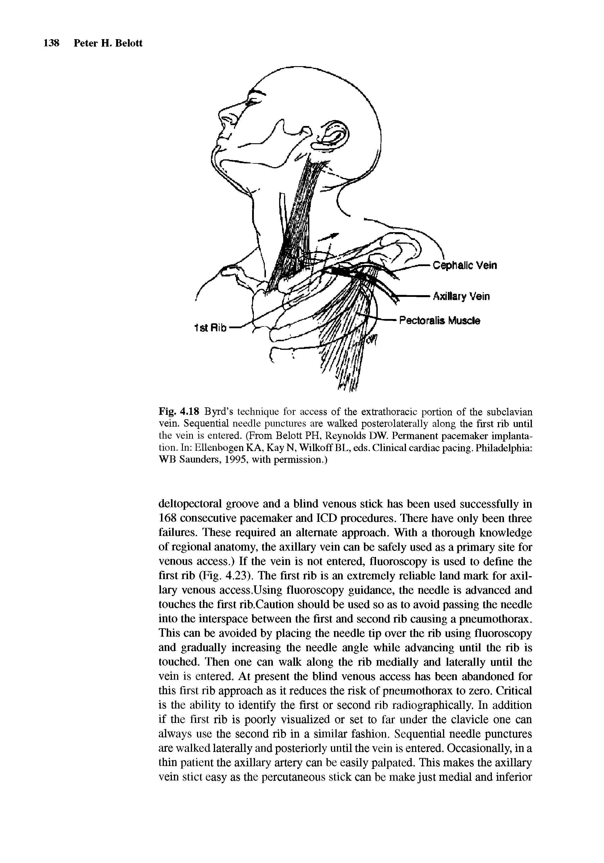 Fig. 4.18 Byrd s technique for access of the extrathoracic portion of the subclavian vein. Sequential needle punctures are walked posterolaterally along the first rib until the vein is entered. (From Belott PH, Reynolds DW. Permanent pacemaker implantation. In EUenbogen KA, Kay N, Wilkoff BL, eds. Clinical cardiac pacing. Philadelphia WB Saunders, 1995, with permission.)...