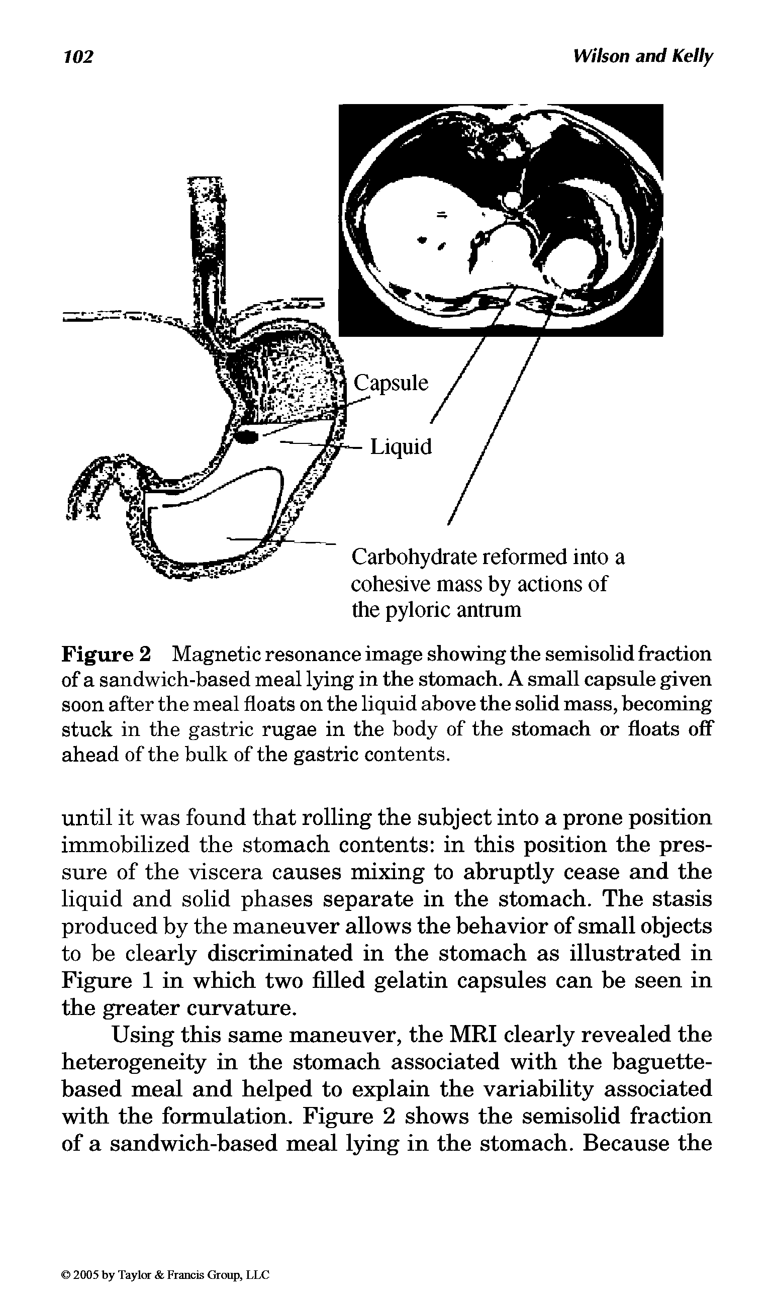Figure 2 Magnetic resonance image showing the semisolid fraction of a sandwich-based meal lying in the stomach. A small capsule given soon after the meal floats on the liquid above the solid mass, becoming stuck in the gastric rugae in the body of the stomach or floats off ahead of the bulk of the gastric contents.