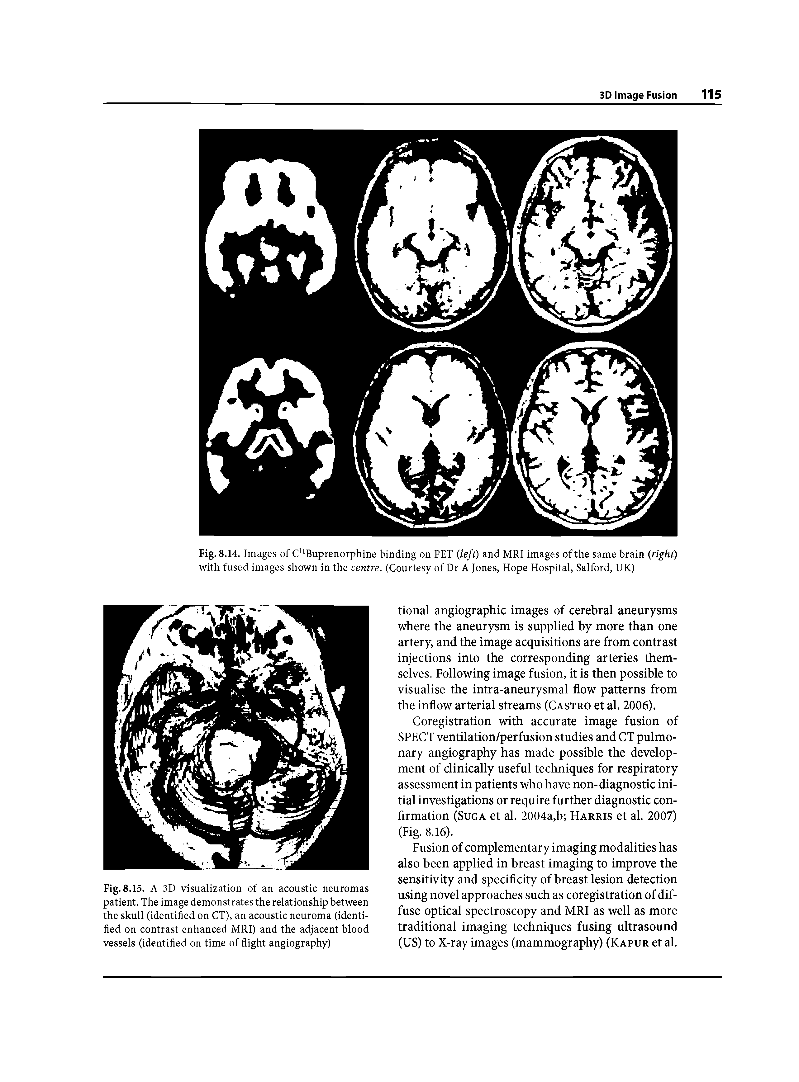Fig. 8.14. Images of C"Buprenorphine binding on PET (left) and MRI images of the same brain (right) with fused images shown in the centre. (Courtesy of Dr A Jones, Hope Hospital, Salford, UK)...