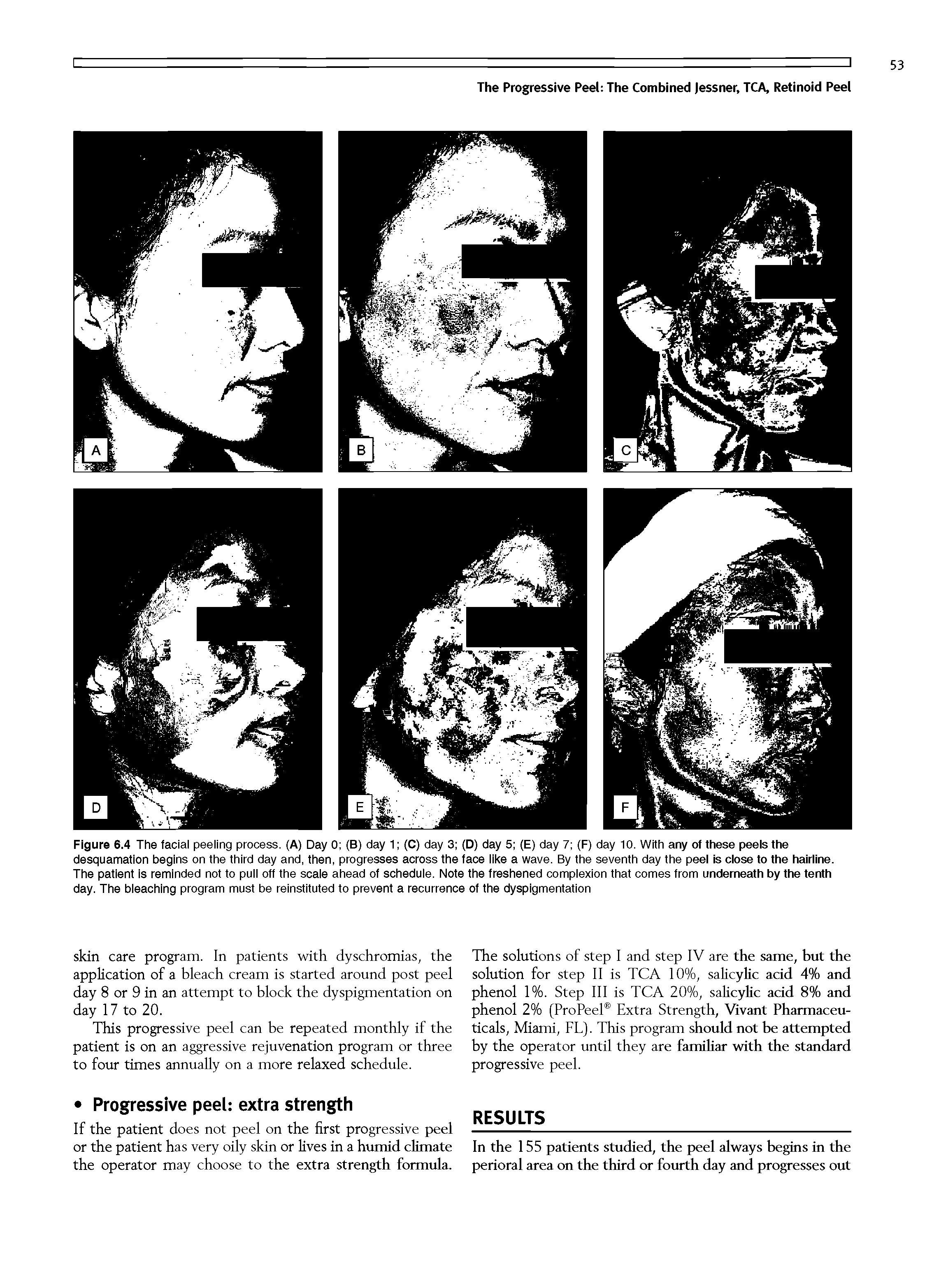 Figure 6.4 The facial peeling process. (A) Day 0 (B) day 1 (C) day 3 (D) day 5 (E) day 7 (F) day 10. With any of these peels the desquamation begins on the third day and, then, progresses across the face like a wave. By the seventh day the peel is close to the hairline. The patient Is reminded not to pull ott the scale ahead of schedule. Note the freshened complexion that comes trom underneath by the tenth day. The bleaching program must be reinstituted to prevent a recurrence of the dyspigmentation...