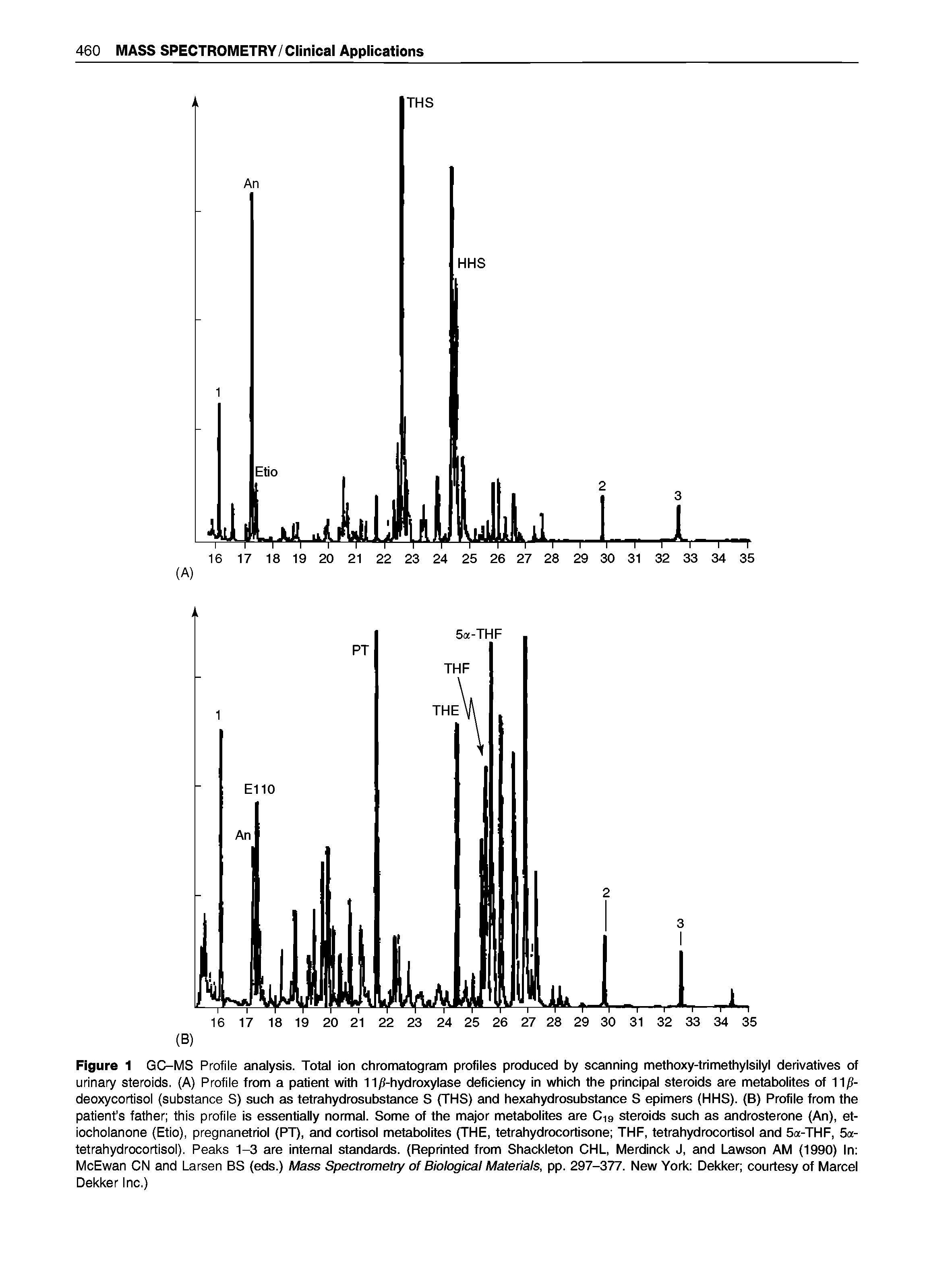 Figure 1 GC-MS Profile analysis. Total ion chromatogram profiles produced by scanning methoxy-trimethylsilyl derivatives of urinary steroids. (A) Profile from a patient with 11 -hydroxylase deficiency in which the principal steroids are metabolites of IIjS-deoxycortisol (substance S) such as tetrahydrosubstance S (THS) and hexahydrosubstance S epimers (HHS). (B) Profile from the patient s father this profile is essentially normal. Some of the major metabolites are C19 steroids such as androsterone (An), et-iocholanone (Etio), pregnanetriol (PT), and cortisol metabolites (THE, tetrahydrocortisone THF, tetrahydrocortisol and 5a-THF, 5a-tetrahydrocortisol). Peaks 1-3 are internal standards. (Reprinted from Shackleton CHL, Merdinck J, and Lawson AM (1990) In McEwan CN and Larsen BS (eds.) Mass Spectrometry of Biological Materials, pp. 297-377. New York Dekker courtesy of Marcel Dekker Inc.)...