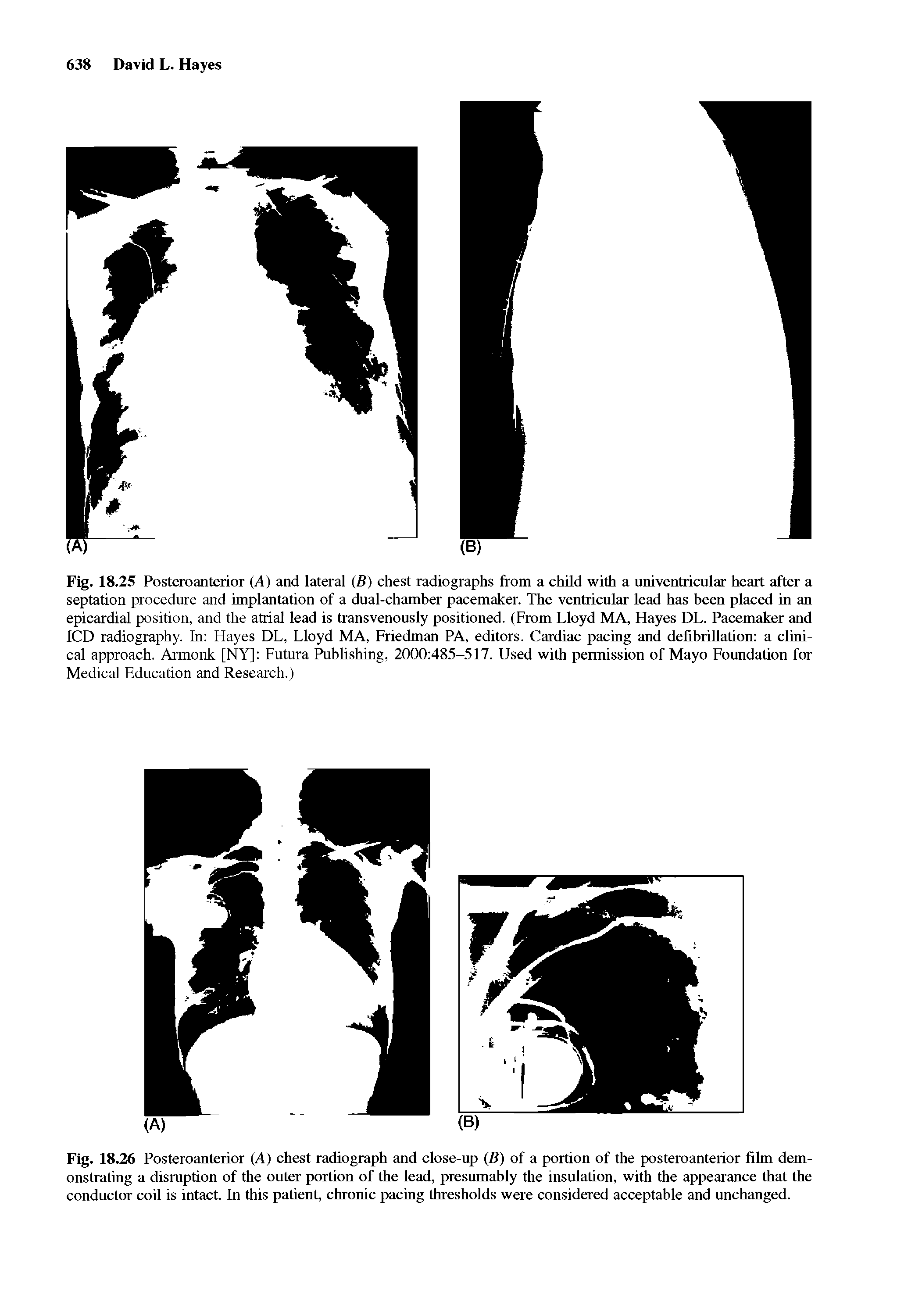 Fig. 18.25 Posteroanterior (A) and lateral (B) chest radiographs from a child with a univentricular heart after a septation procedure and implantation of a dual-chamber pacemaker. The ventricular lead has been placed in an epicardial position, and the atrial lead is transvenously positioned. (From Lloyd MA, Hayes DL. Pacemaker and ICD radiography. In Hayes DL, Lloyd MA, Friedman PA, editors. Cardiac pacing and defibriUation a clinical approach. Armonk [NY] Futura Publishing, 2000 485-517. Used with permission of Mayo Foundation for Medical Education and Research.)...