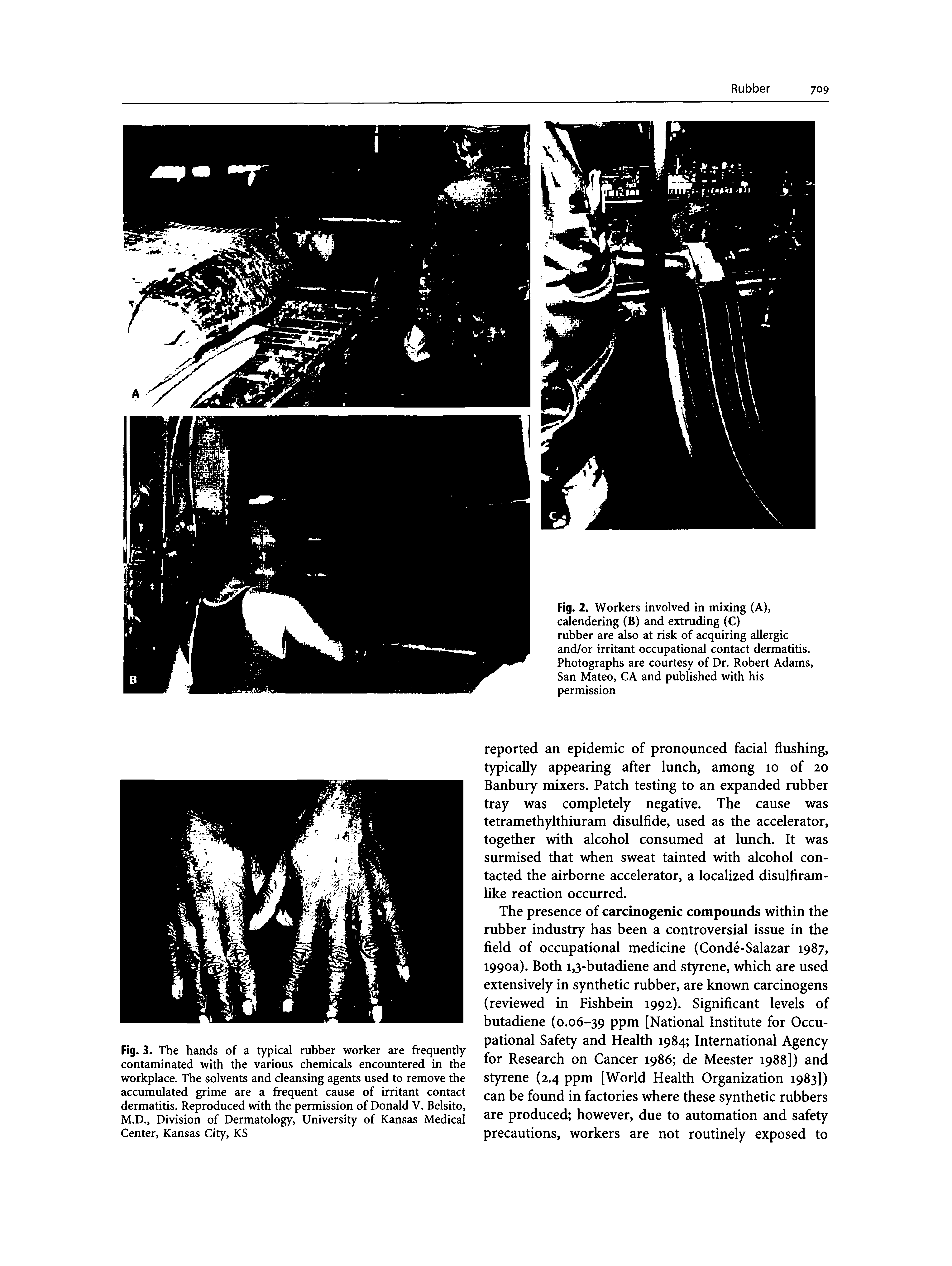 Fig. 3. The hands of a typical rubber worker are frequently contaminated with the various chemicals encountered in the workplace. The solvents and cleansing agents used to remove the accumulated grime are a frequent cause of irritant contact dermatitis. Reproduced with the permission of Donald V. Belsito, M.D., Division of Dermatology, University of Kansas Medical Center, Kansas City, KS...