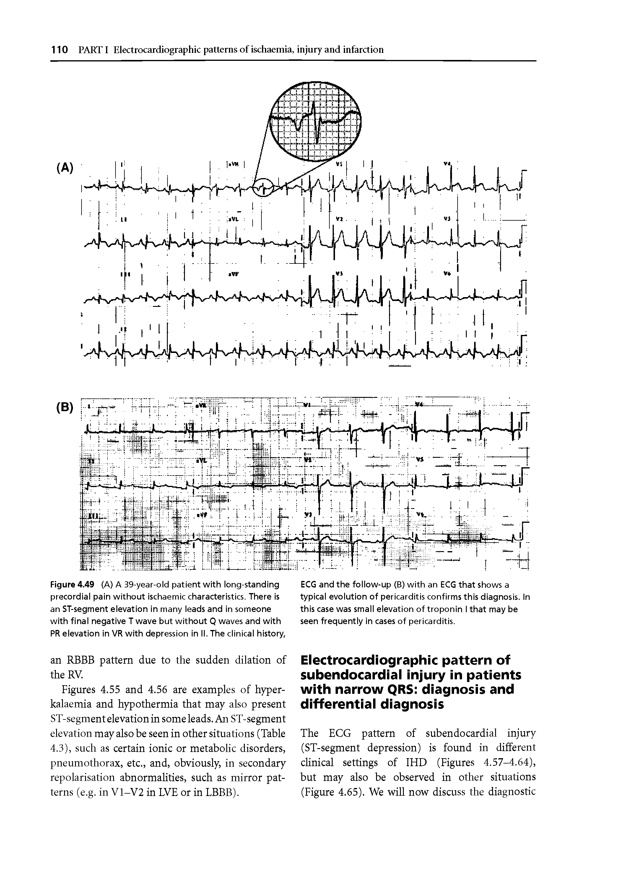 Figures 4.55 and 4.56 are examples of hyper-kalaemia and hypothermia that may also present ST-segment elevation in some leads. An ST-segment elevation may also be seen in other situations (Table 4.3), such as certain ionic or metabolic disorders, pneumothorax, etc., and, obviously, in secondary repolarisation abnormalities, such as mirror patterns (e.g. in V1-V2 in LVE or in LBBB).
