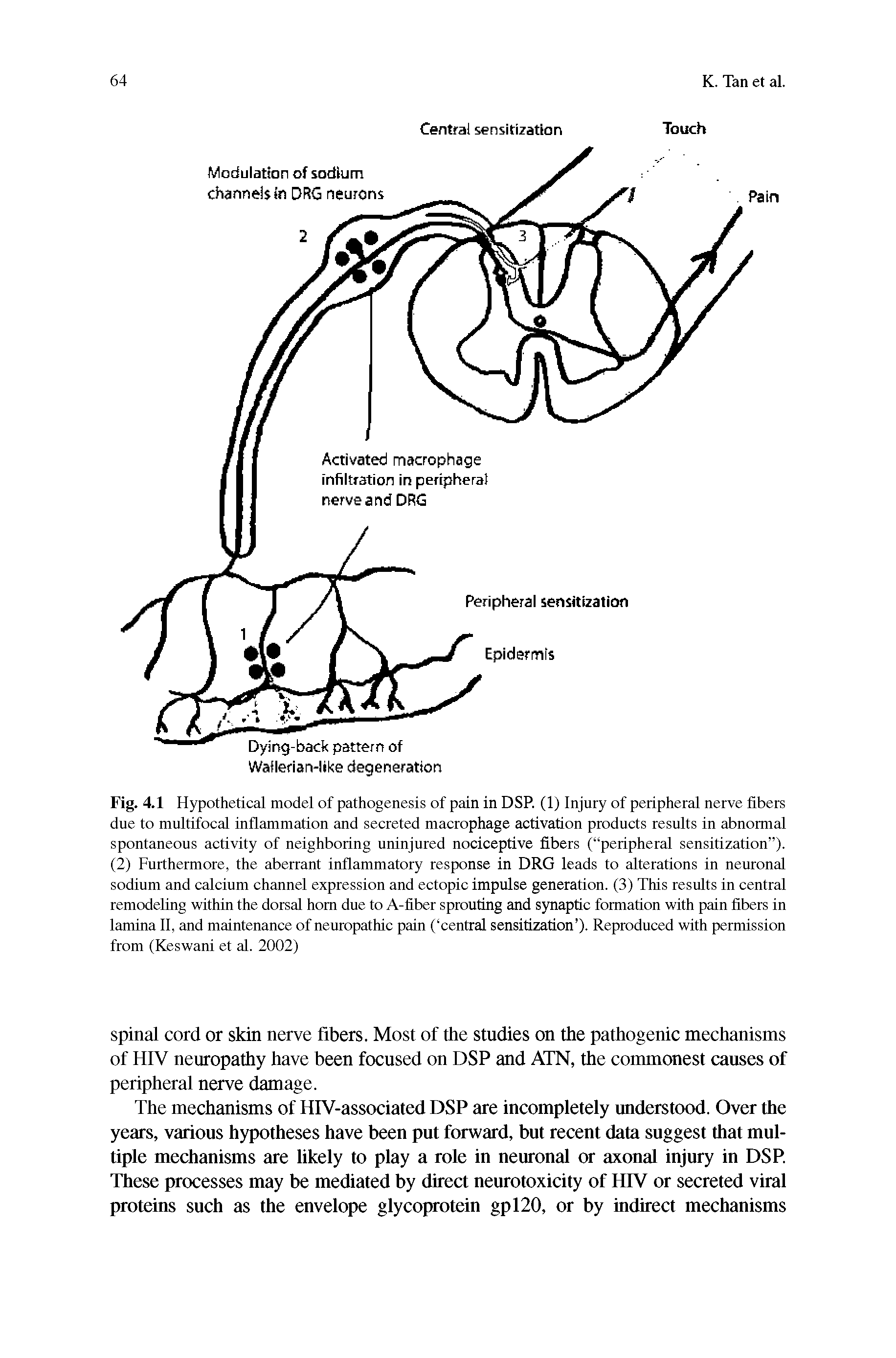 Fig. 4.1 Hypothetical model of pathogenesis of pain in DSP. (1) Injury of peripheral nerve fibers due to multifocal inflammation and secreted macrophage activation products results in abnormal spontaneous activity of neighboring uninjured nociceptive fibers ( peripheral sensitization ). (2) Furthermore, the aberrant inflammatory response in DRG leads to alterations in neuronal sodium and calcium channel expression and ectopic impulse generation. (3) This results in central remodeling within the dorsal horn due to A-fiber sprouting and synaptic formation with pain fibers in lamina 11, and maintenance of neuropathic pain ( central sensitization ). Reproduced with permission from (Keswani et al. 2002)...