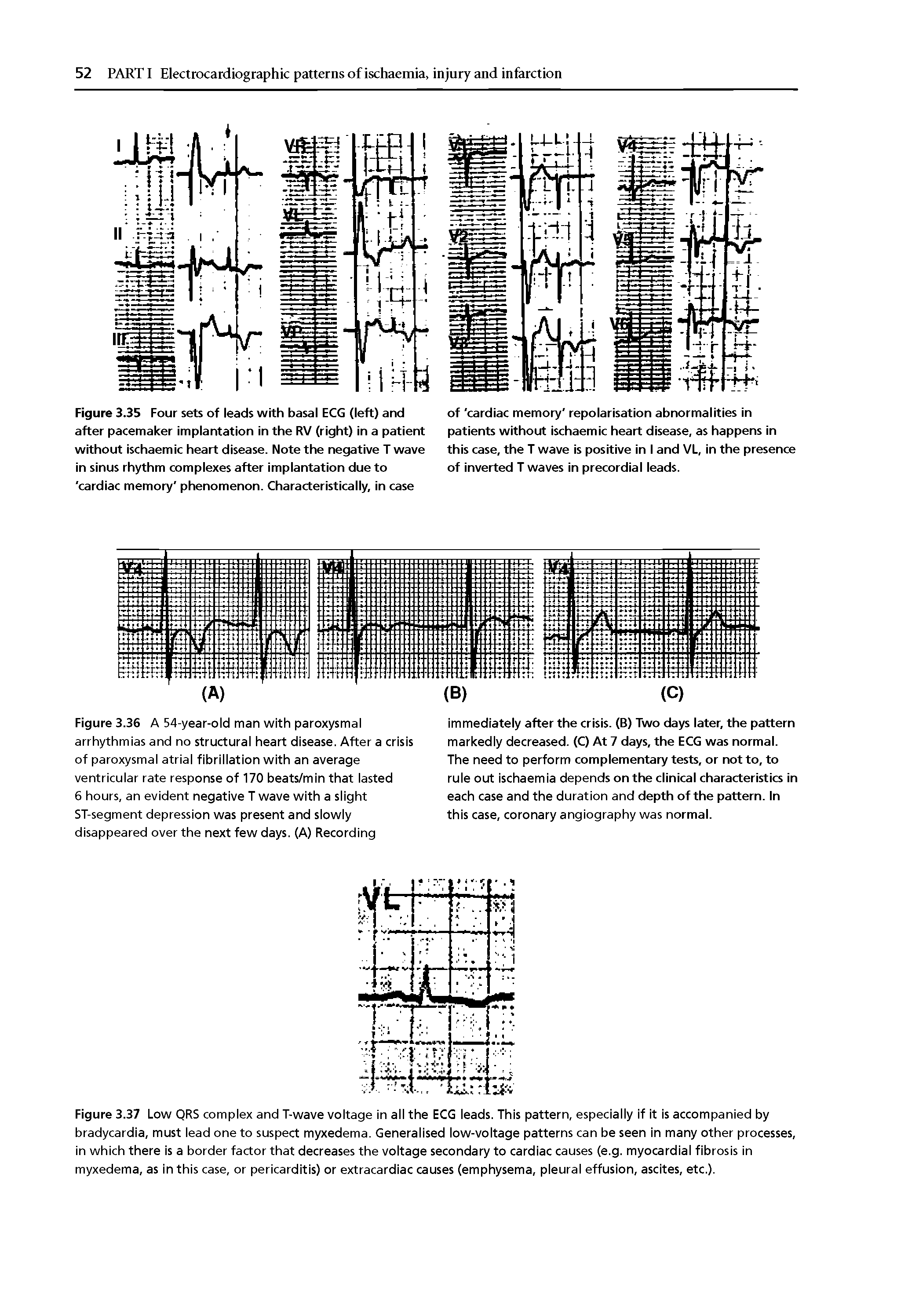 Figure 3.35 Four sets of leads with basal ECG (left) and after pacemaker implantation in the RV (right) in a patient without ischaemic heart disease. Note the negative T wave in sinus rhythm complexes after implantation due to cardiac memory phenomenon. Characteristically, in case...