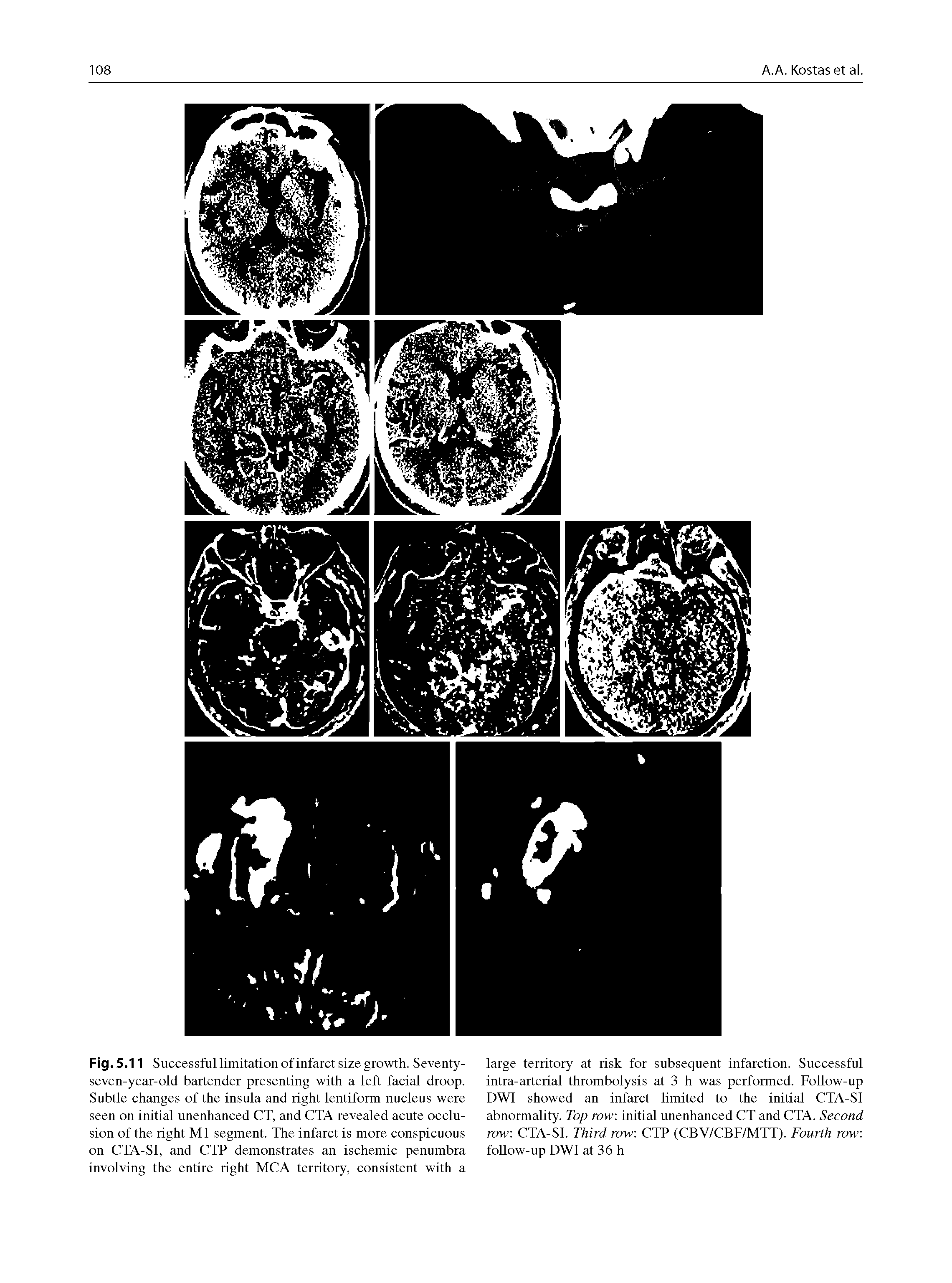 Fig.5.11 Successful limitation of infarct size growth. Seventy-seven-year-old bartender presenting with a left facial droop. Subtle changes of the insula and right lentiform nucleus were seen on initial unenhanced CT, and CTA revealed acute occlusion of the right Ml segment. The infarct is more conspicuous on CTA-SI, and CTP demonstrates an ischemic penumbra involving the entire right MCA territory, consistent with a...