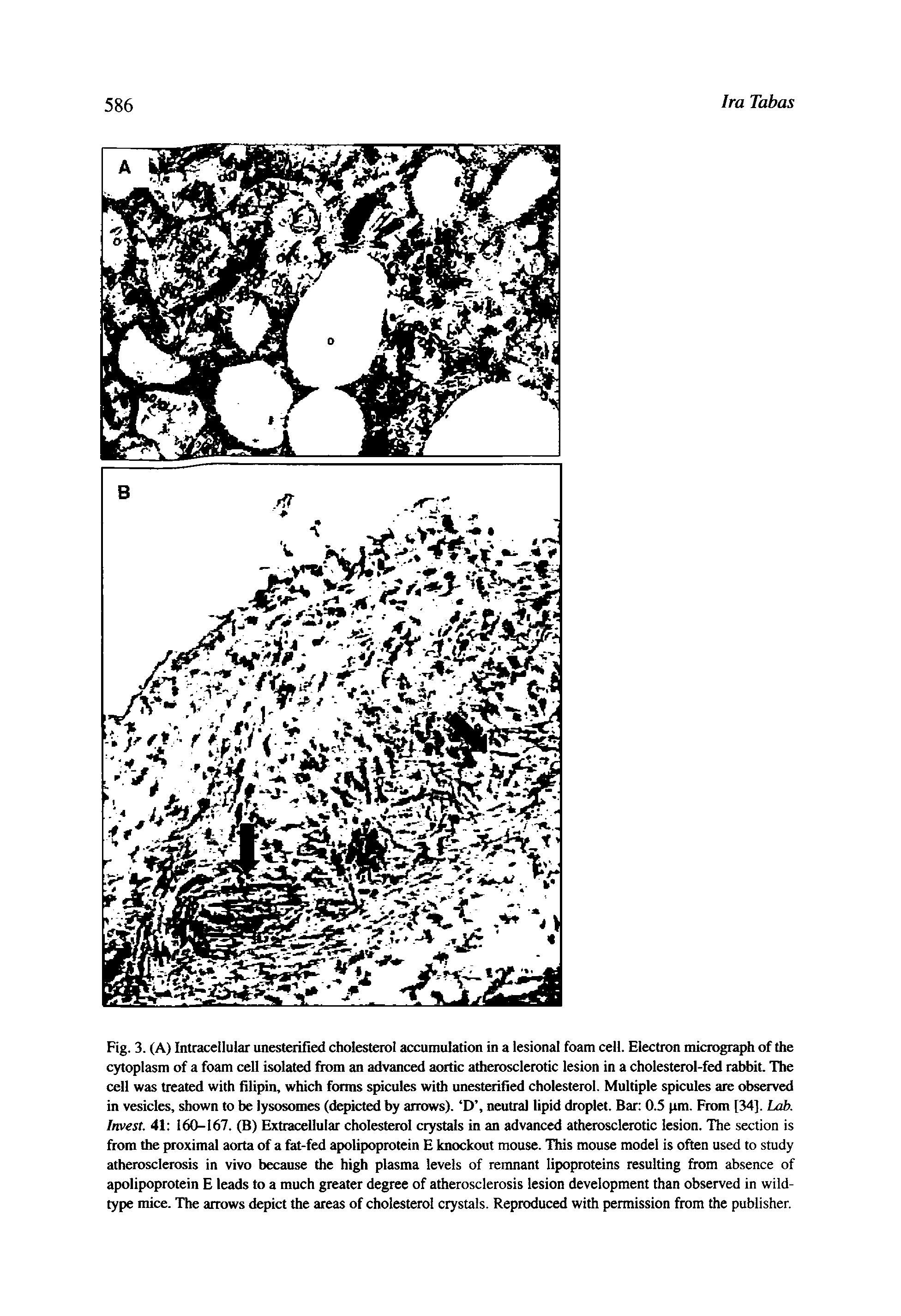 Fig. 3. (A) Intracellular unesterified cholesterol accumulation in a lesional foam cell. Electron micrograph of the cytoplasm of a foam cell isolated ftom an advanced aortic atherosclerotic lesion in a cholesterol-fed rabbit. The cell was treated with filipin, which forms spicules with unesterified cholesterol. Multiple spicules are observed in vesicles, shown to be lysosomes (depicted by arrows). D , neutral lipid droplet. Bar 0.5 pm. From [34]. Lab. Invest. 41 160-167. (B) Extracellular cholesterol crystals in an advanced atherosclerotic lesion. The section is from the proximal aorta of a fat-fed apolipoprotein E knockout mouse. This mouse model is often used to study atherosclerosis in vivo because the high plasma levels of remnant lipoproteins resulting from absence of apolipoprotein E leads to a much greater degree of atherosclerosis lesion development than observed in wild-type mice. The arrows depict the areas of cholesterol crystals. Reproduced with permission from the publisher.