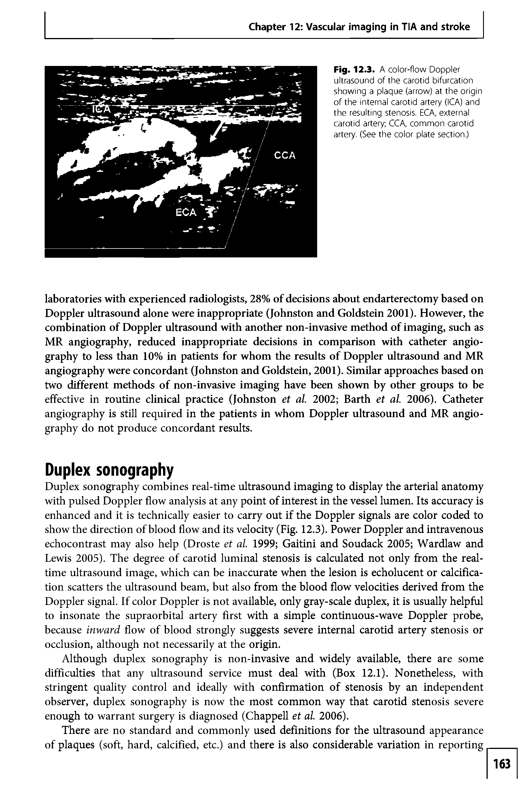 Fig. 12.3. A color-flow Doppler ultrasourid of the carotid bifurcatlori showirig a plaque (arrow) at the origiri of the Iriterrial carotid artery (ICA) arid the resulting stenosis. ECA, external carotid artery CCA, common carotid artery. (See the color plate section.)...