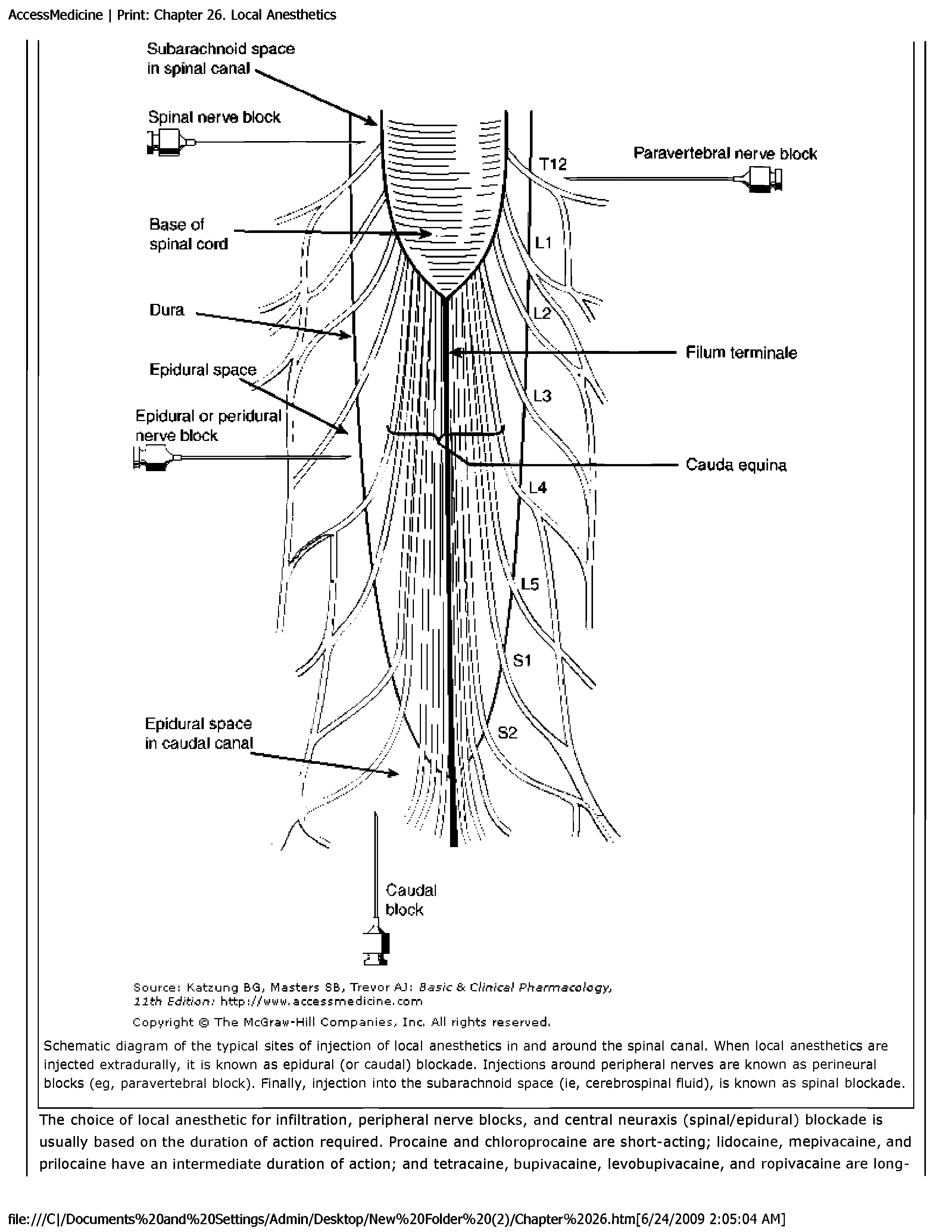 Schematic diagram of the typical sites of injection of local anesthetics in and around the spinal canal. When local anesthetics are injected extradurally, it is known as epidural (or caudal) blockade. Injections around peripheral nerves are known as perineural blocks (eg, paravertebral block). Finally, injection into the subarachnoid space (ie, cerebrospinal fluid), is known as spinal blockade.