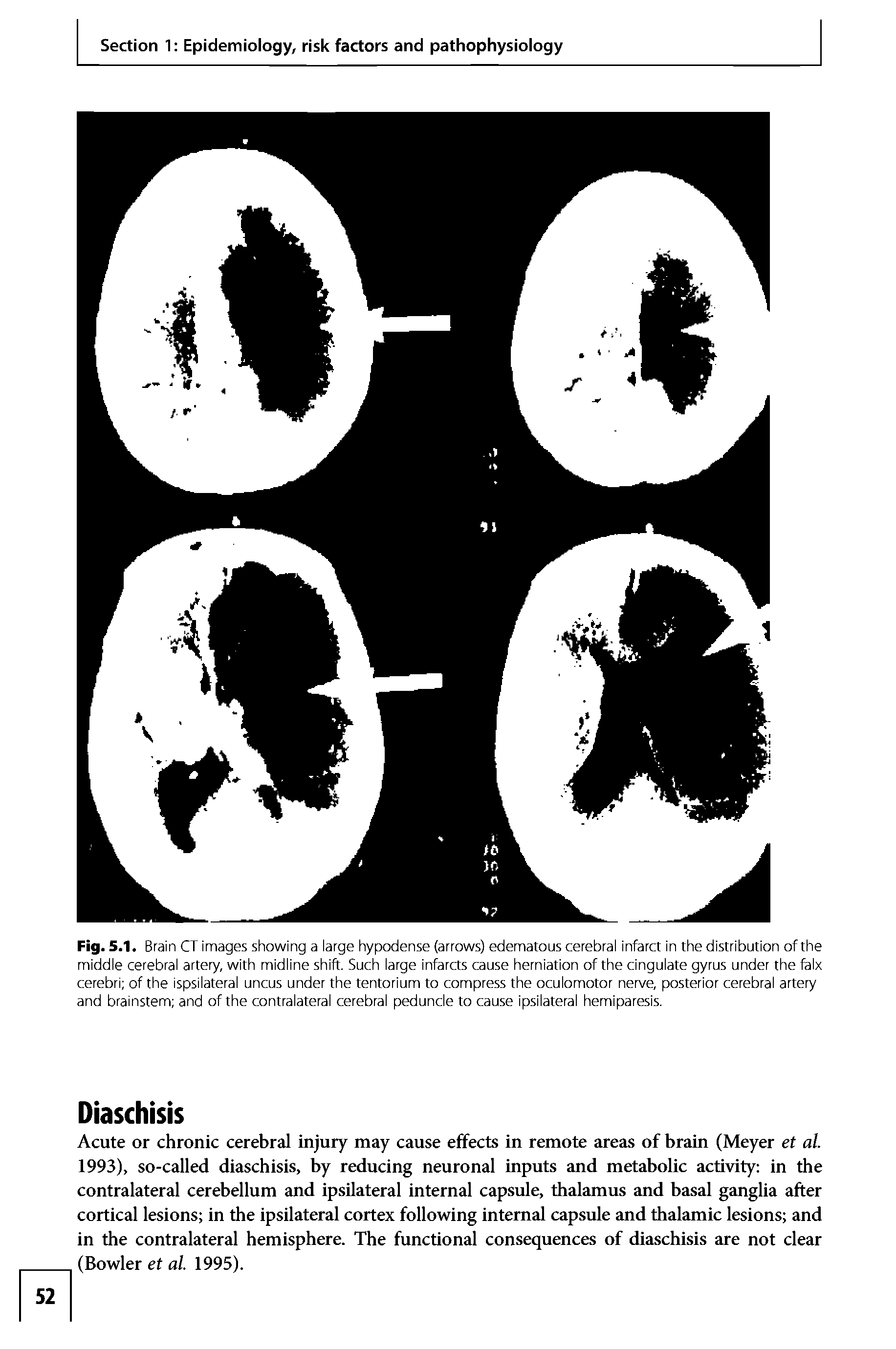 Fig. 5.1. Brain CT images showing a large hypodense (arrows) edematous cerebral infarct in the distribution of the middle cerebral artery, with midline shift. Such large infarcts cause herniation of the cingulate gyrus under the falx cerebri of the ispsilateral uncus under the tentorium to compress the oculomotor nerve, posterior cerebral artery and brainstem and of the contralateral cerebral peduncle to cause ipsilateral hemiparesis.