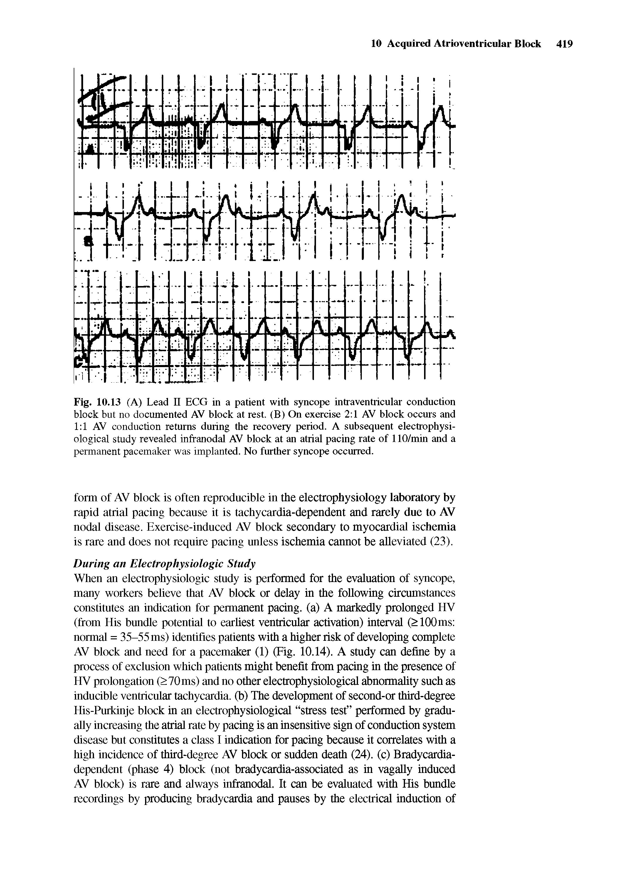 Fig. 10.13 (A) Lead II ECG in a patient with syncope intraventricular conduction block but no documented AV block at rest. (B) On exercise 2 1 AV block occurs and 1 1 AV conduction returns during the recovery period. A subsequent electrophysi-ological study revealed infranodal AV block at an atrial pacing rate of 110/min and a permanent pacemaker was implanted. No further syncope occurred.