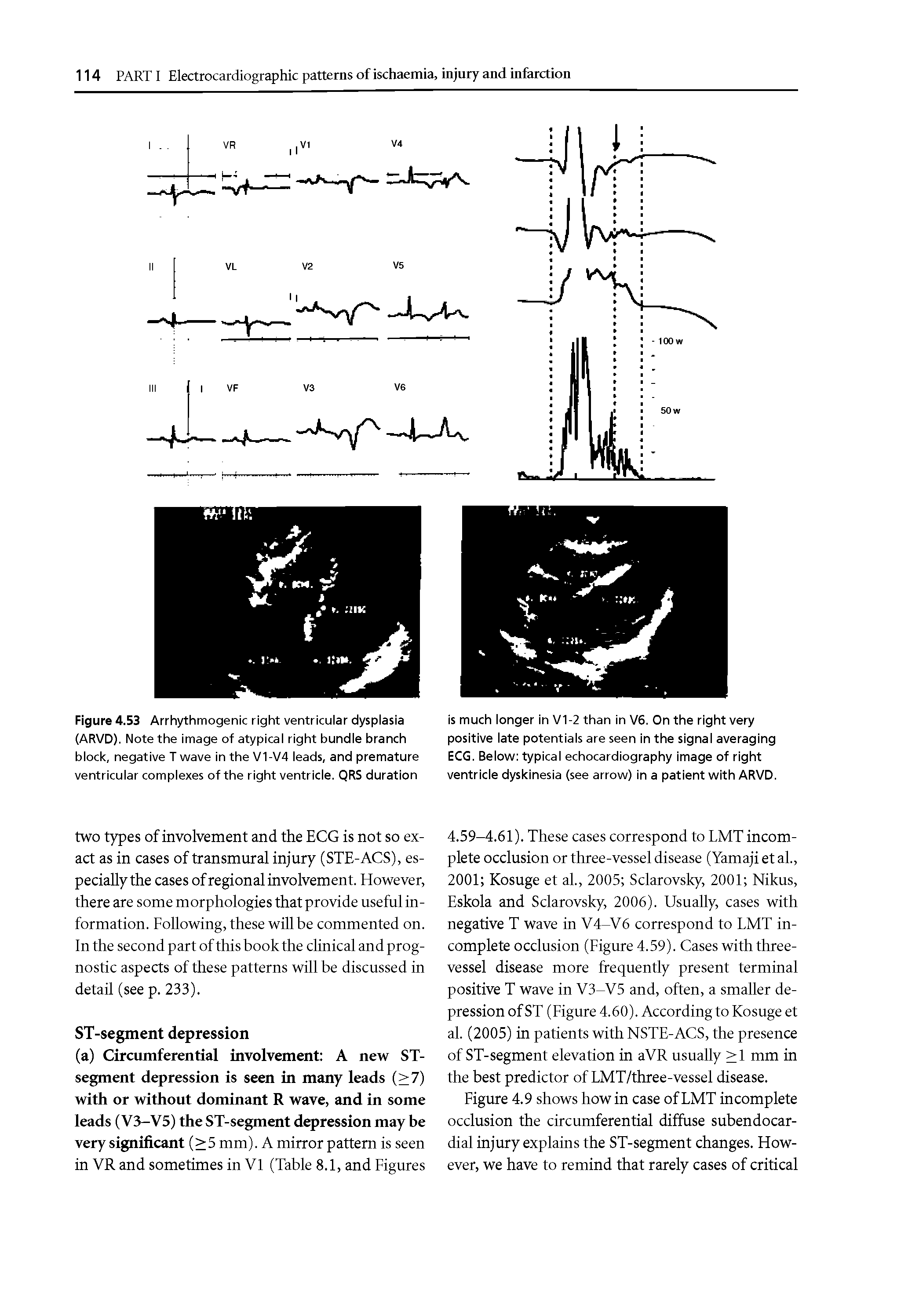 Figure 4.53 Arrhythmogenic right ventricular dysplasia (ARVD). Note the image of atypical right bundle branch block, negative T wave in the V1-V4 leads, and premature ventricular complexes of the right ventricle. QRS duration...