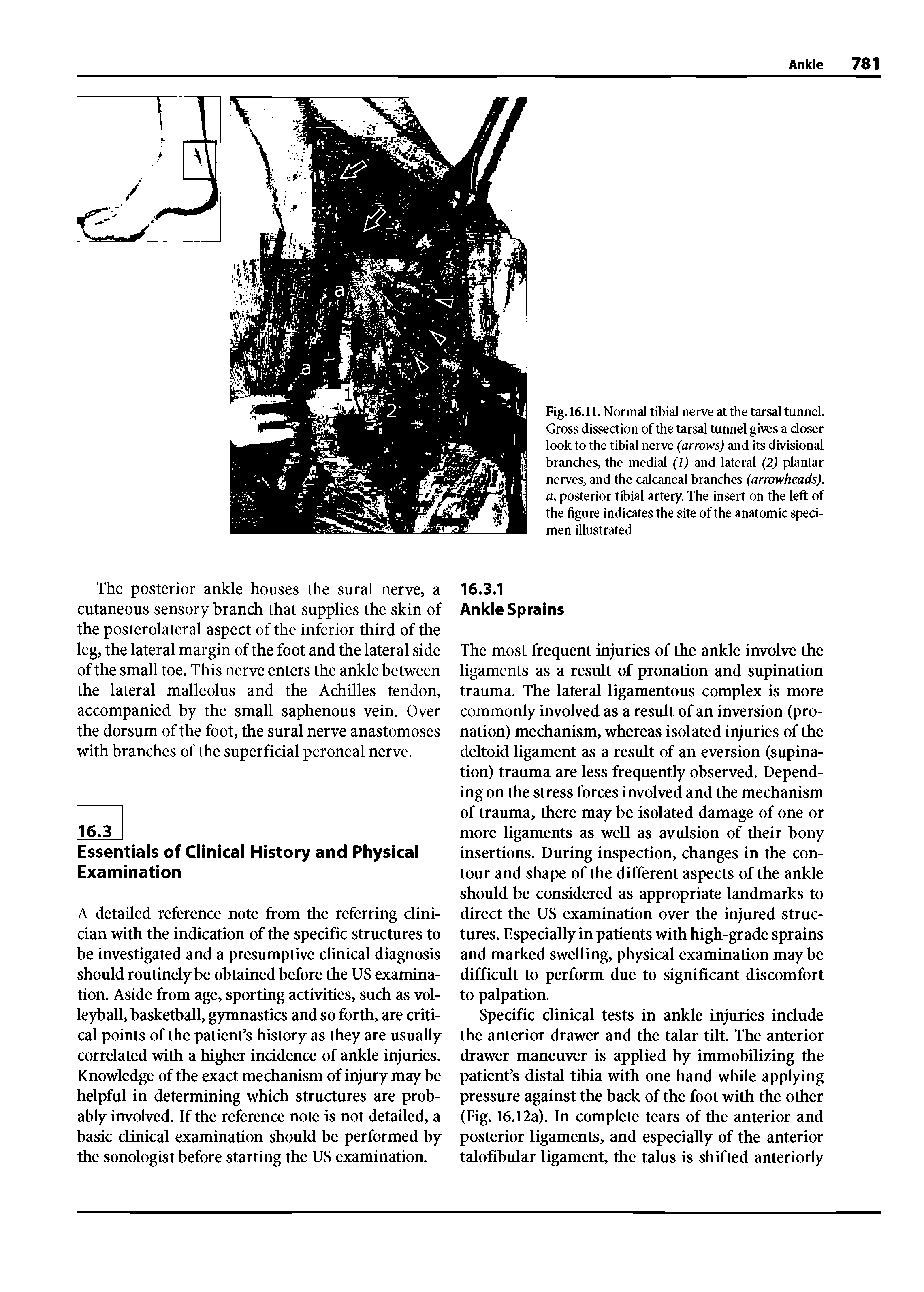 Fig.16.11. Normal tibial nerve at the tarsal tunneL Gross dissection of the tarsal tunnel gives a closer look to the tibial nerve (arrows) and its divisional branches, the medial (1) and lateral (2) plantar nerves, and the calcaneal branches (arrowheads), a, posterior tibial artery. The insert on the left of the figure indicates the site of the anatomic specimen illustrated...