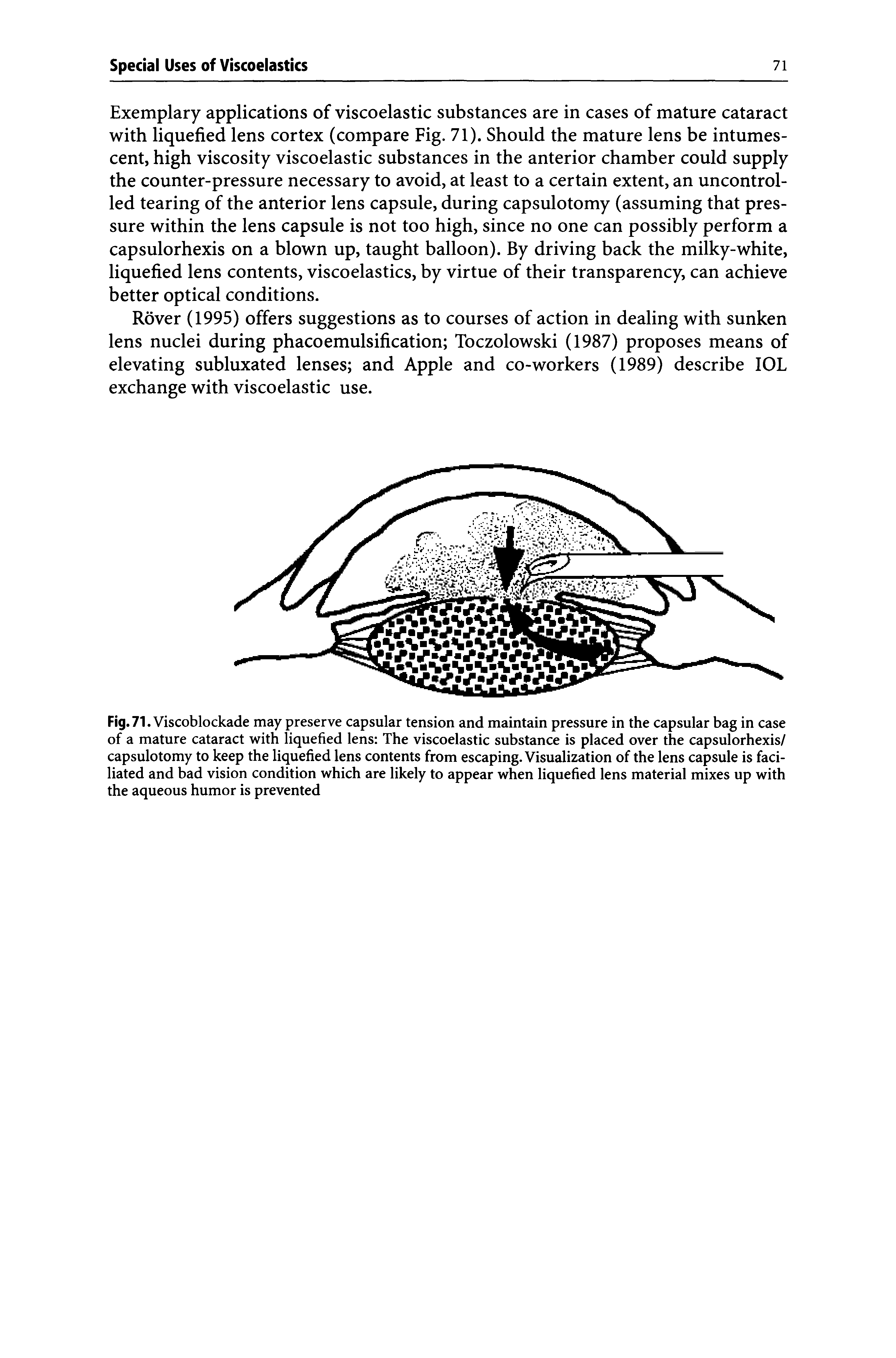 Fig. 71. Viscoblockade may preserve capsular tension and maintain pressure in the capsular bag in case of a mature cataract with liquefied lens The viscoelastic substance is placed over the capsulorhexis/ capsulotomy to keep the liquefied lens contents from escaping. Visualization of the lens capsule is faci-liated and bad vision condition which are likely to appear when liquefied lens material mixes up with the aqueous humor is prevented...