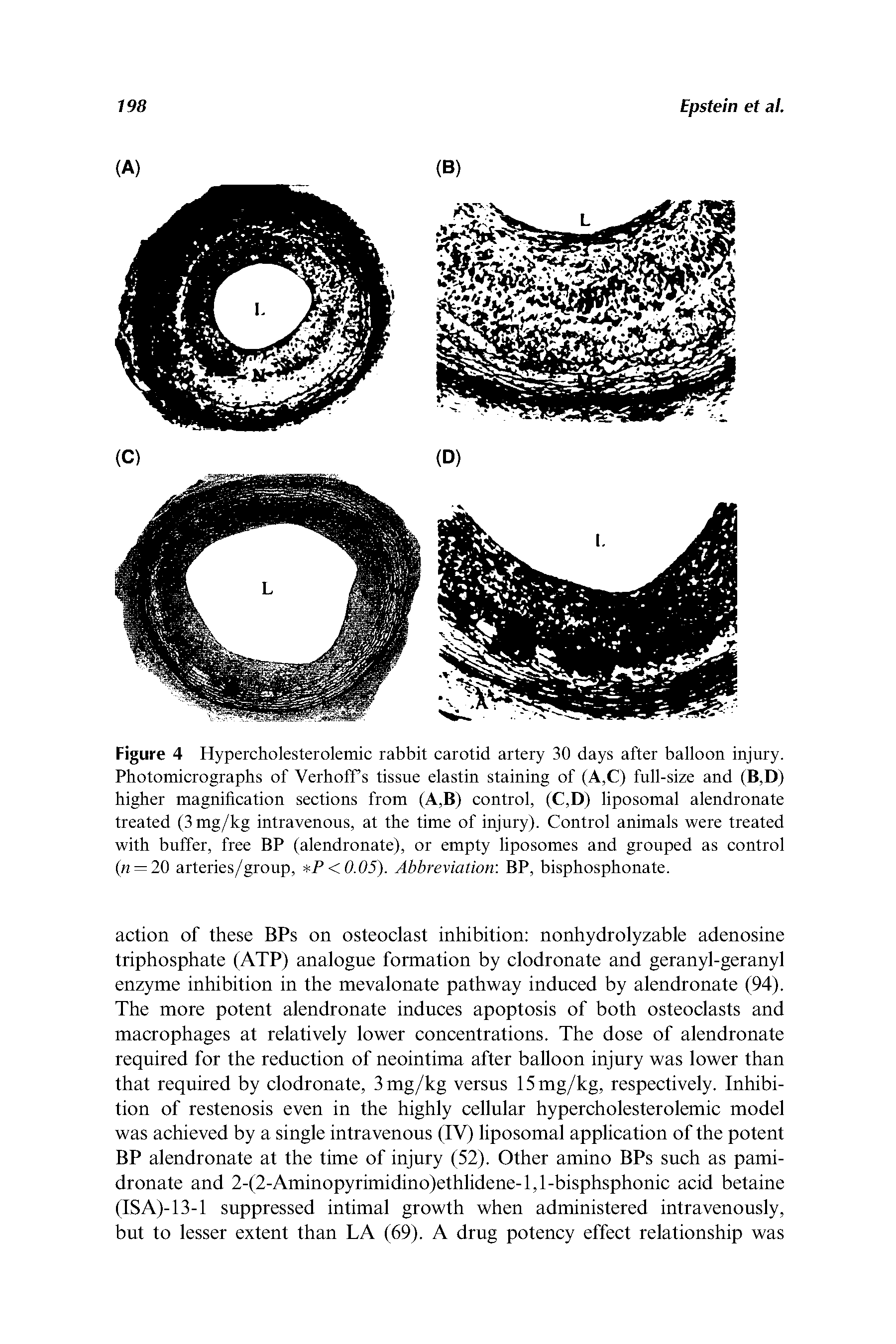 Figure 4 Hypercholesterolemic rabbit carotid artery 30 days after balloon injury. Photomicrographs of Verhoff s tissue elastin staining of (A,C) full-size and (B,D) higher magnification sections from (A,B) control, (C,D) liposomal alendronate treated (3mg/kg intravenous, at the time of injury). Control animals were treated with buffer, free BP (alendronate), or empty liposomes and grouped as control (n — 20 arteries/group, P<0.05). Abbreviation BP, bisphosphonate.
