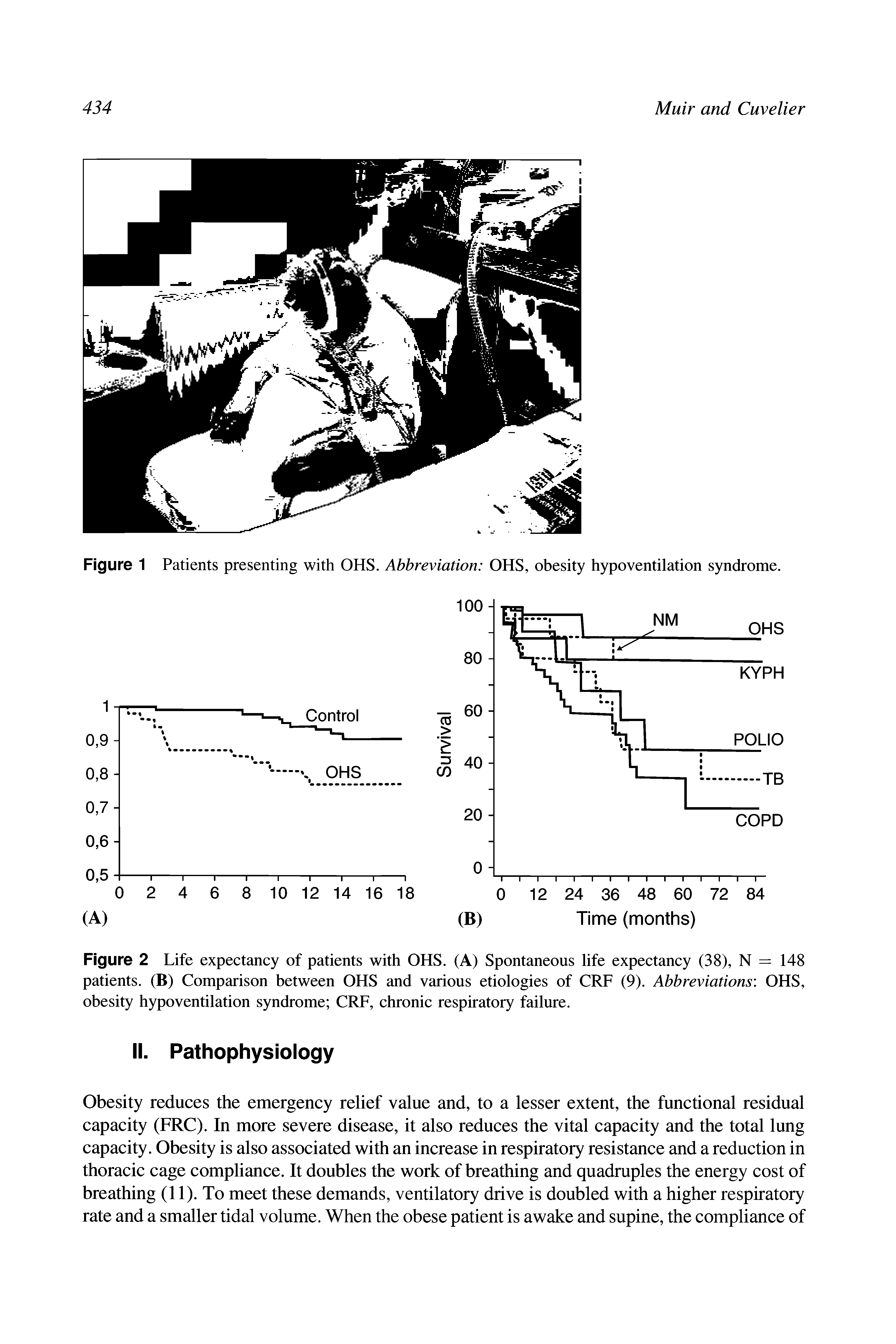 Figure 1 Patients presenting with OHS. Abbreviation OHS, obesity hypoventilation syndrome.