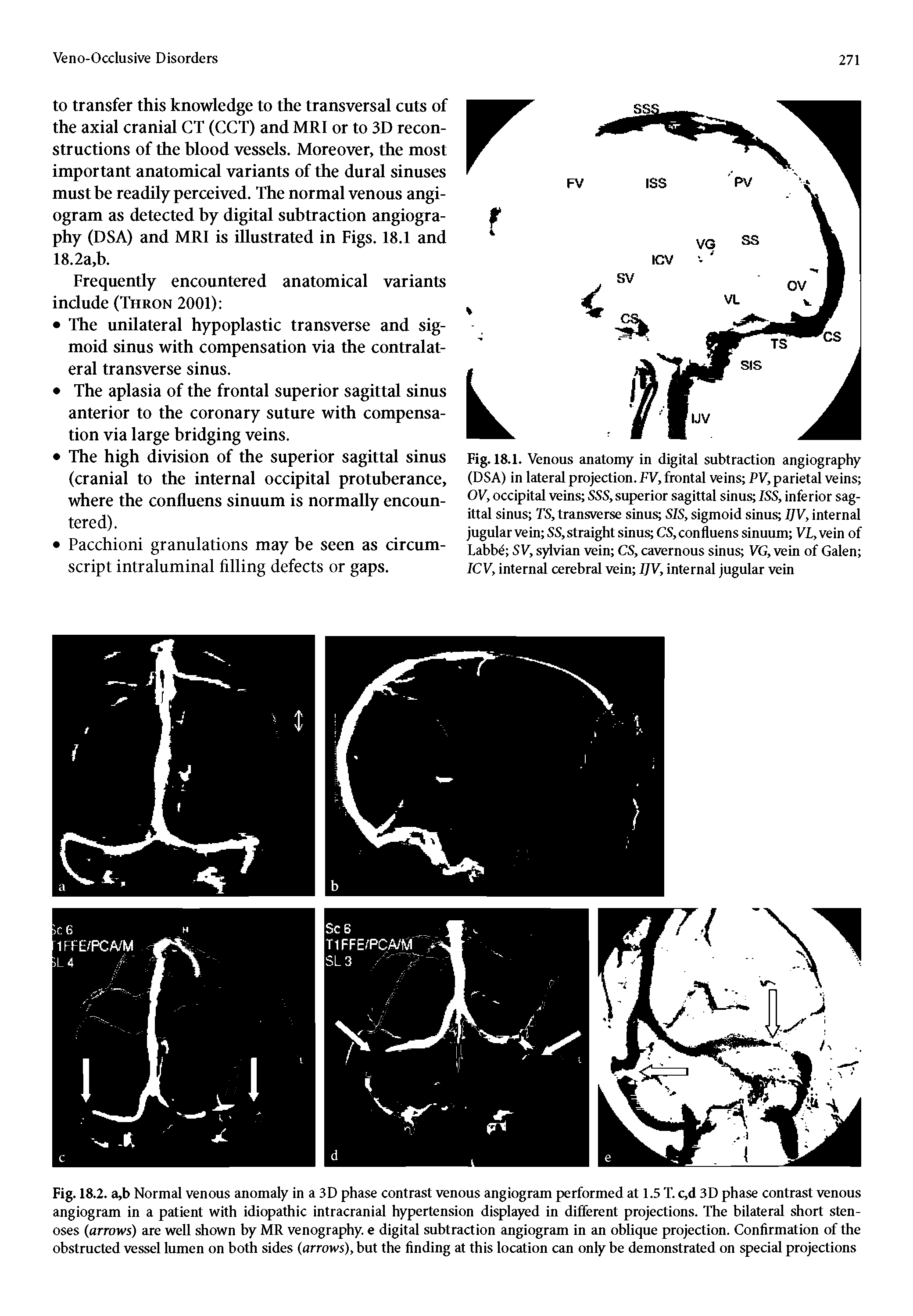 Fig. 18.1. Venous anatomy in digital subtraction angiography (DSA) in lateral projection. FV, frontal veins PV, parietal veins OV, occipital veins SSS, superior sagittal sinus ISS, inferior sagittal sinus TS, transverse sinus SIS, sigmoid sinus IJV, internal jugular vein SS, straight sinus CS, confluens sinuum VL, vein of I.abbe SV, sylvian vein CS, cavernous sinus VG, vein of Galen 1CV, internal cerebral vein IJV, internal jugular vein...