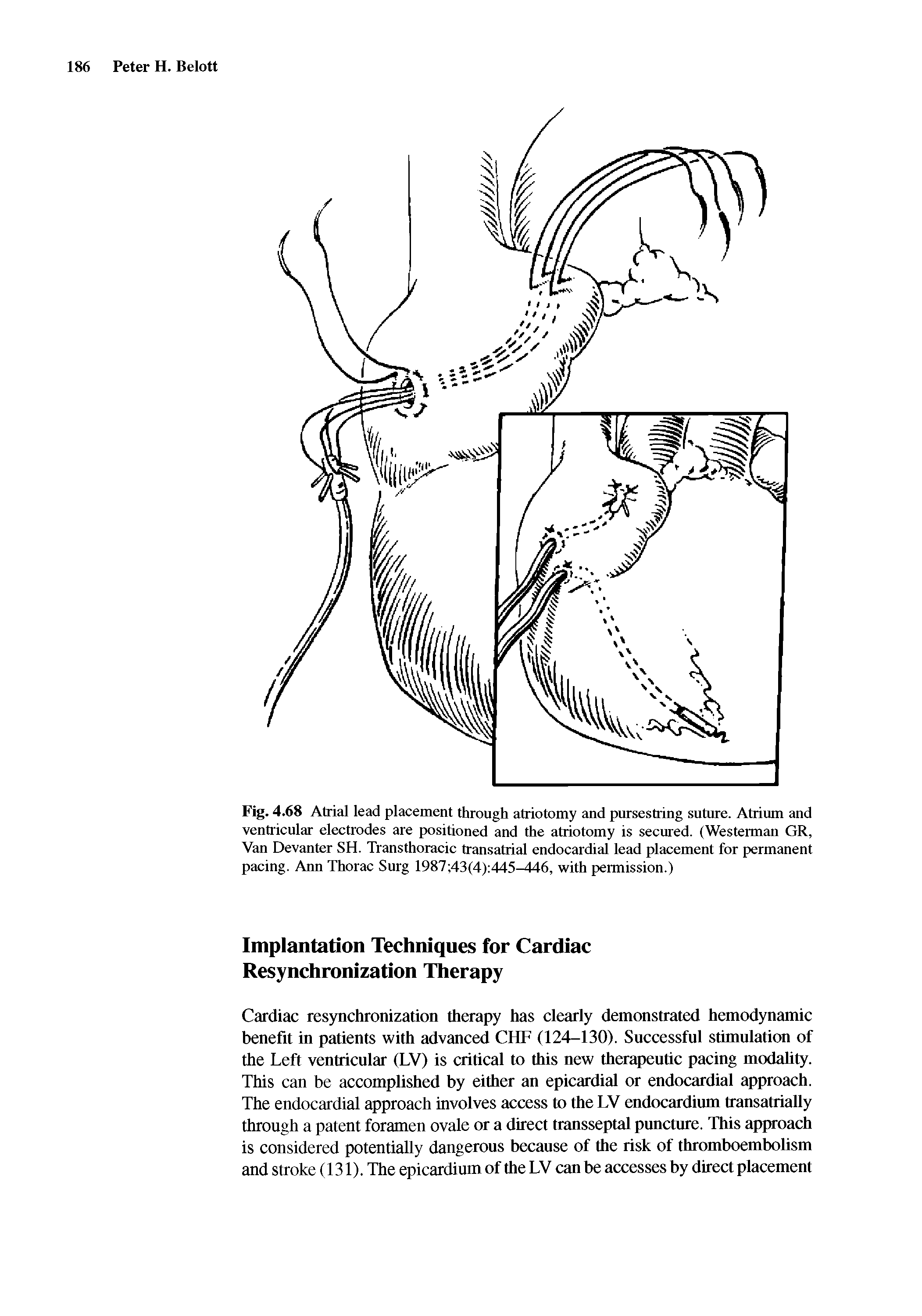 Fig. 4.68 Atrial lead placement through atriotomy and purseslring suture. Atrium and ventricular electrodes are positioned and the atriotomy is secured. (Westerman GR, Van Devanter SH. Transthoracic transatrial endocardial lead placement for permanent pacing. Ann Thorac Surg 1987 43(4) 445-446, with permission.)...