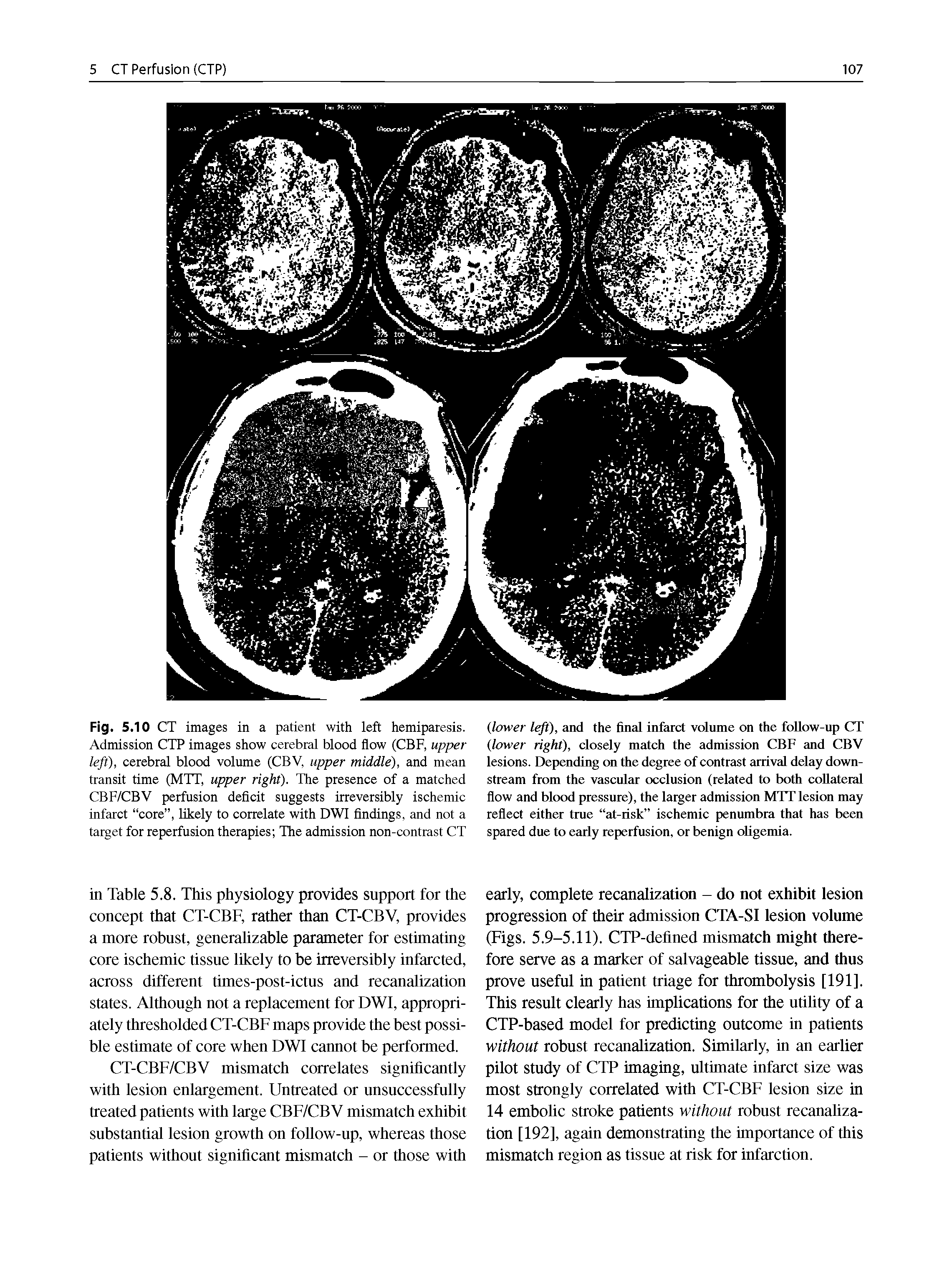 Fig. 5.10 CT images in a patient with left hemiparesis. Admission CTP images show cerebral blood flow (CBF, upper left), cerebral blood volume (CBV, upper middle), and mean transit time (MTT, upper right). The presence of a matched CBF/CBV perfusion deficit suggests irreversibly ischemic infarct core , likely to correlate with DWI findings, and not a target for reperfusion therapies The admission non-contrast CT...