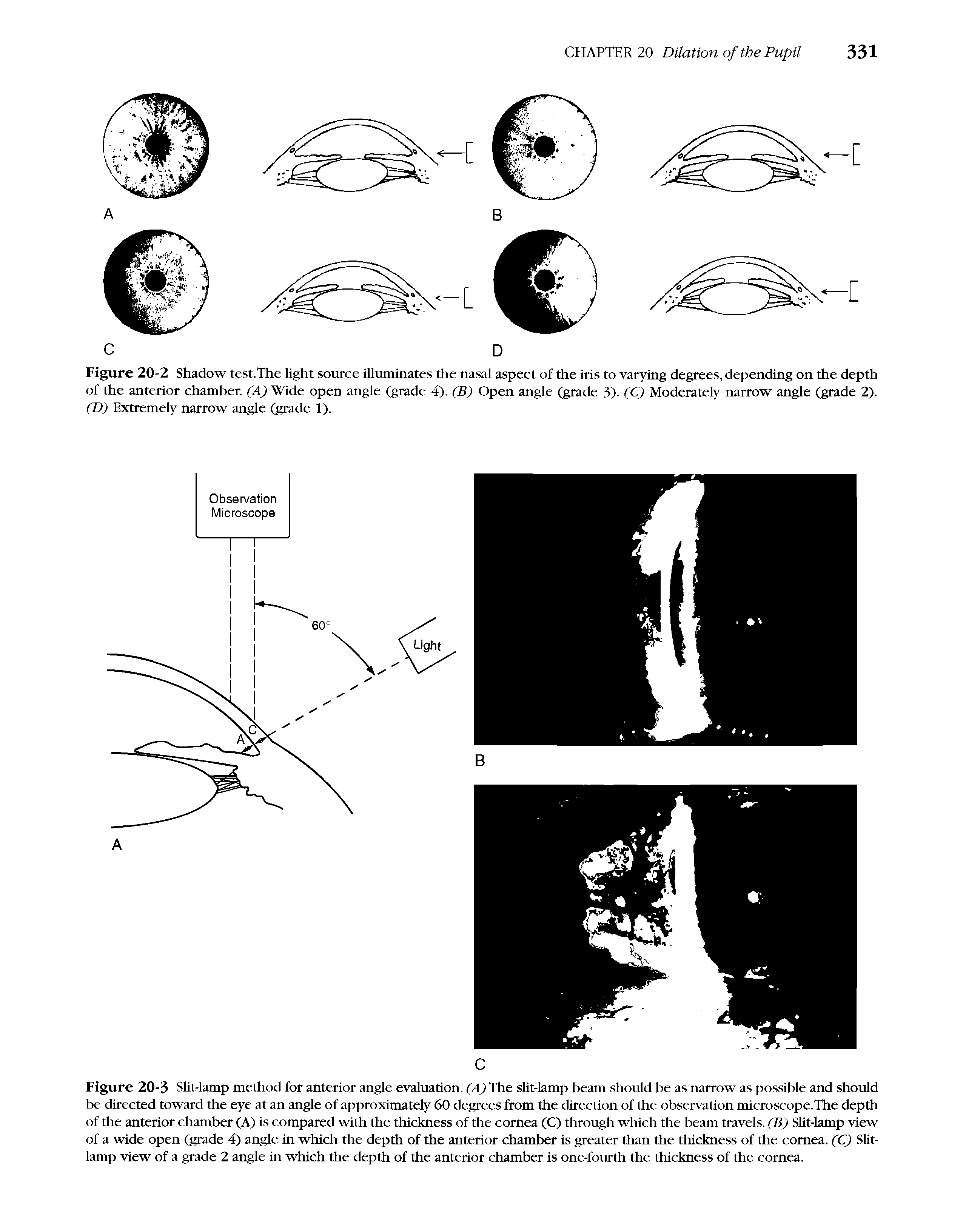 Figure 20-3 SUt-lamp method for anterior angle evaluation. (A) The sUt-lamp beam should be as narrow as possible and should be directed toward the eye at an angle of approximately 60 degrees from the direction of the observation microscope.The depth of the anterior chamber (A) is compared with the thickness of the cornea (C) through which the beam travels. (B) SUt-lamp view of a wide open (grade 4) angle in which the depth of the anterior chamber is greater than the thickness of the cornea. CC) SUt-lamp view of a grade 2 angle in which the depth of the anterior chamber is one-fourth the thickness of the cornea.