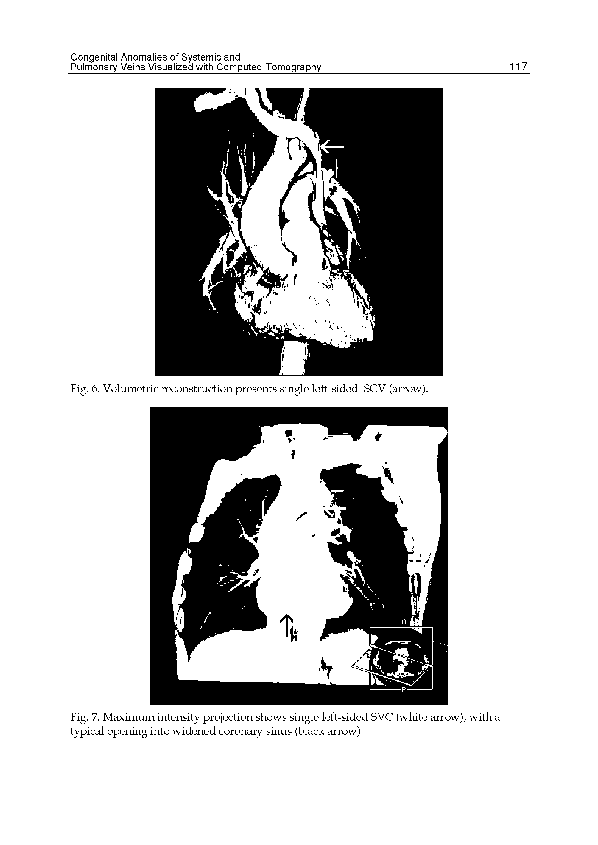 Fig. 7. Maximum intensity projection shows single left-sided SVC (white arrow), with a typical opening into widened coronary sinus (black arrow).