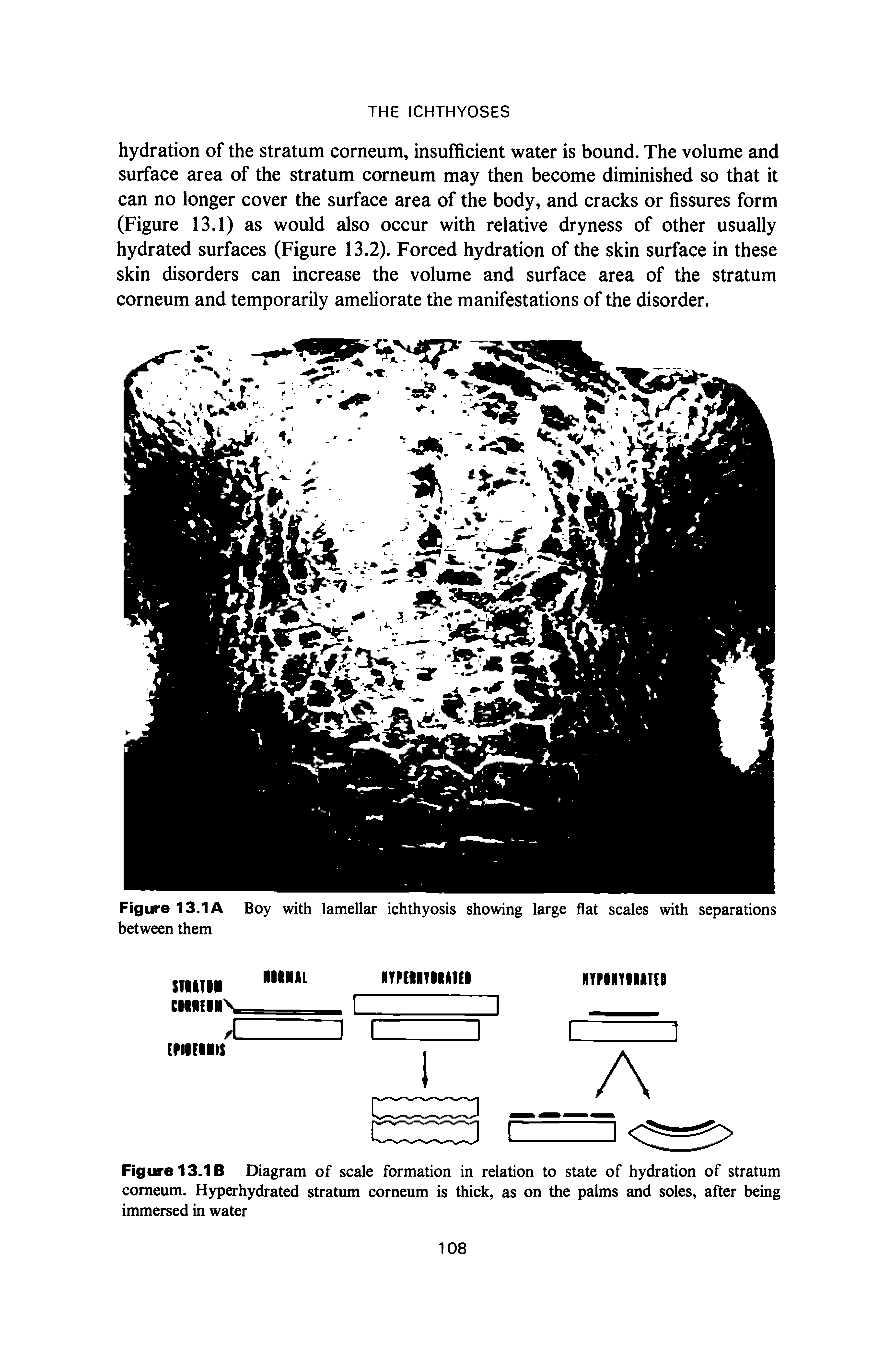 Figure 13.1 B Diagram of scale formation in relation to state of hydration of stratum corneum. Hyperhydrated stratum corneum is thick, as on the palms and soles, after being immersed in water...