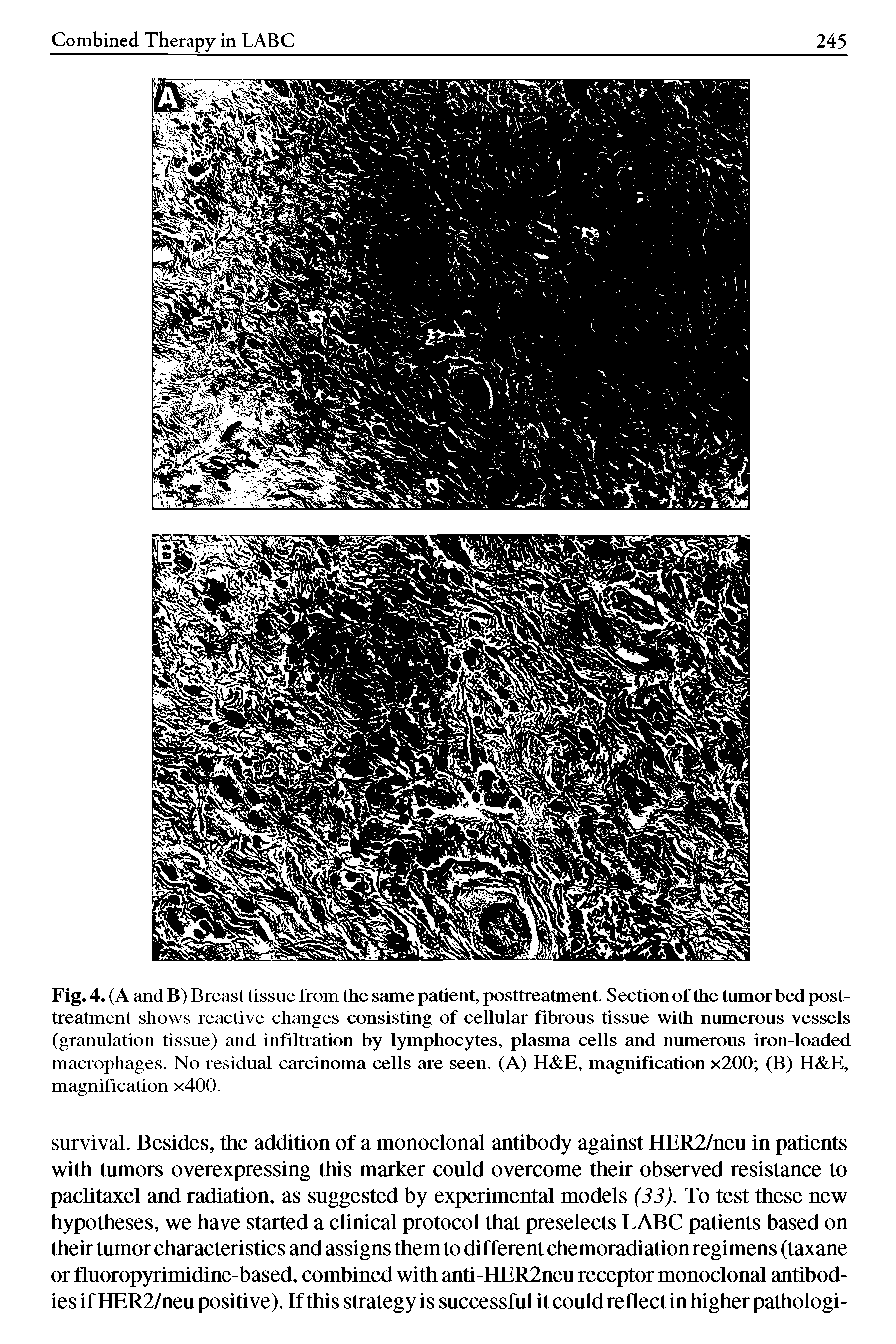 Fig. 4. (A and B) Breast tissue from the same patient, posttreatment. Section of the tumor bed posttreatment shows reactive changes consisting of cellular fibrous tissue with numerous vessels (granulation tissue) and infiltration by lymphocytes, plasma cells and numerous iron-loaded macrophages. No residual carcinoma cells are seen. (A) H E, magnification x200 (B) H E, magnification x400.