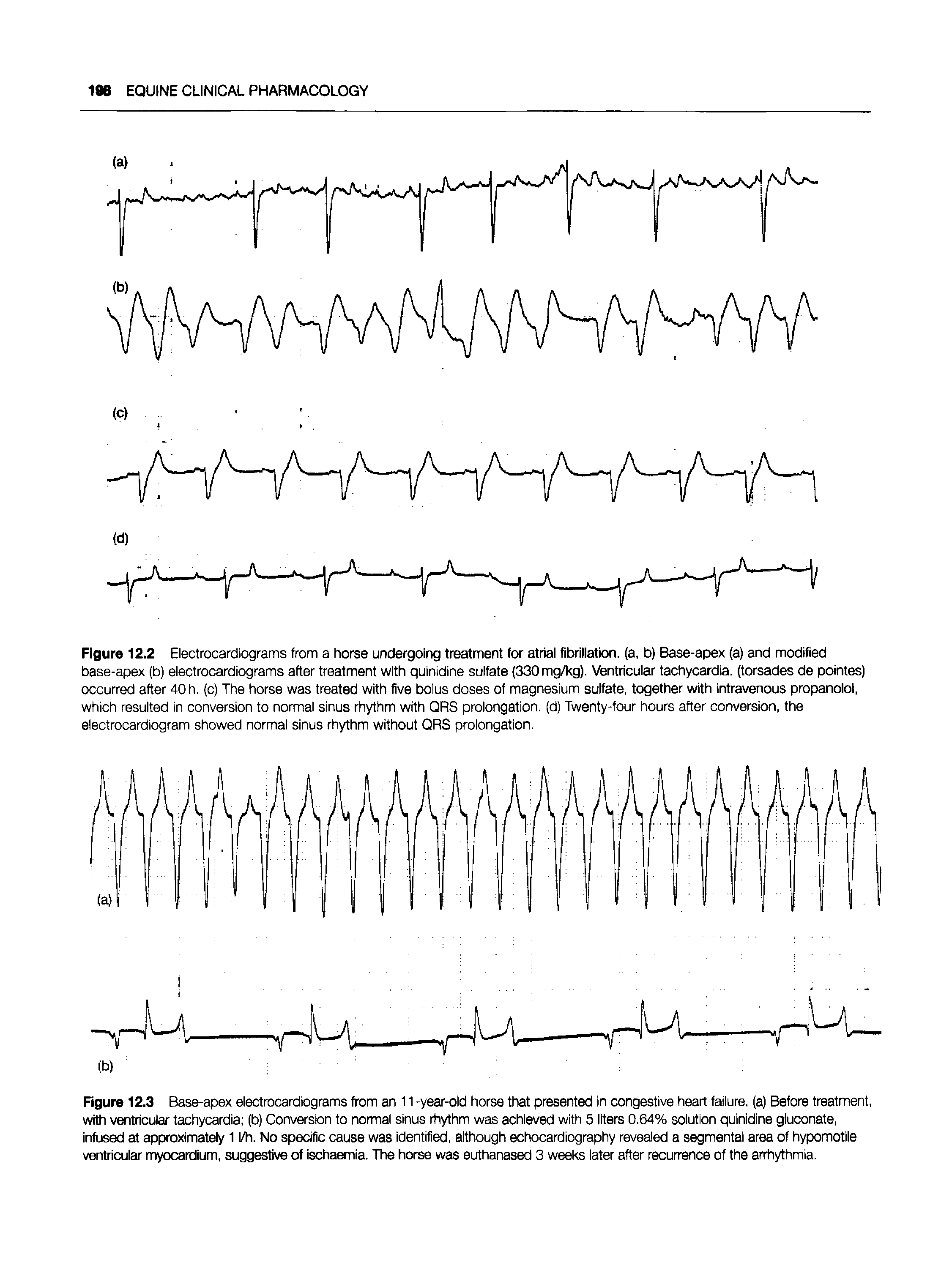 Figure 12.3 Base-apex electrocardiograms from an 11 -year-old horse that presented in congestive heart failure, (a) Before treatment, with ventricular tachycardia (b) Conversion to normal sinus rhythm was achieved with 5 liters 0.64% solution quinidine giuconate, infused at approximately 1 l/h. No specific cause was identified, although echocardiography revealed a segmental area of hypomotile ventricular myocardium, suggestive of ischaemia. The horse was euthanased 3 weeks later after recurrence of the arrhythmia.