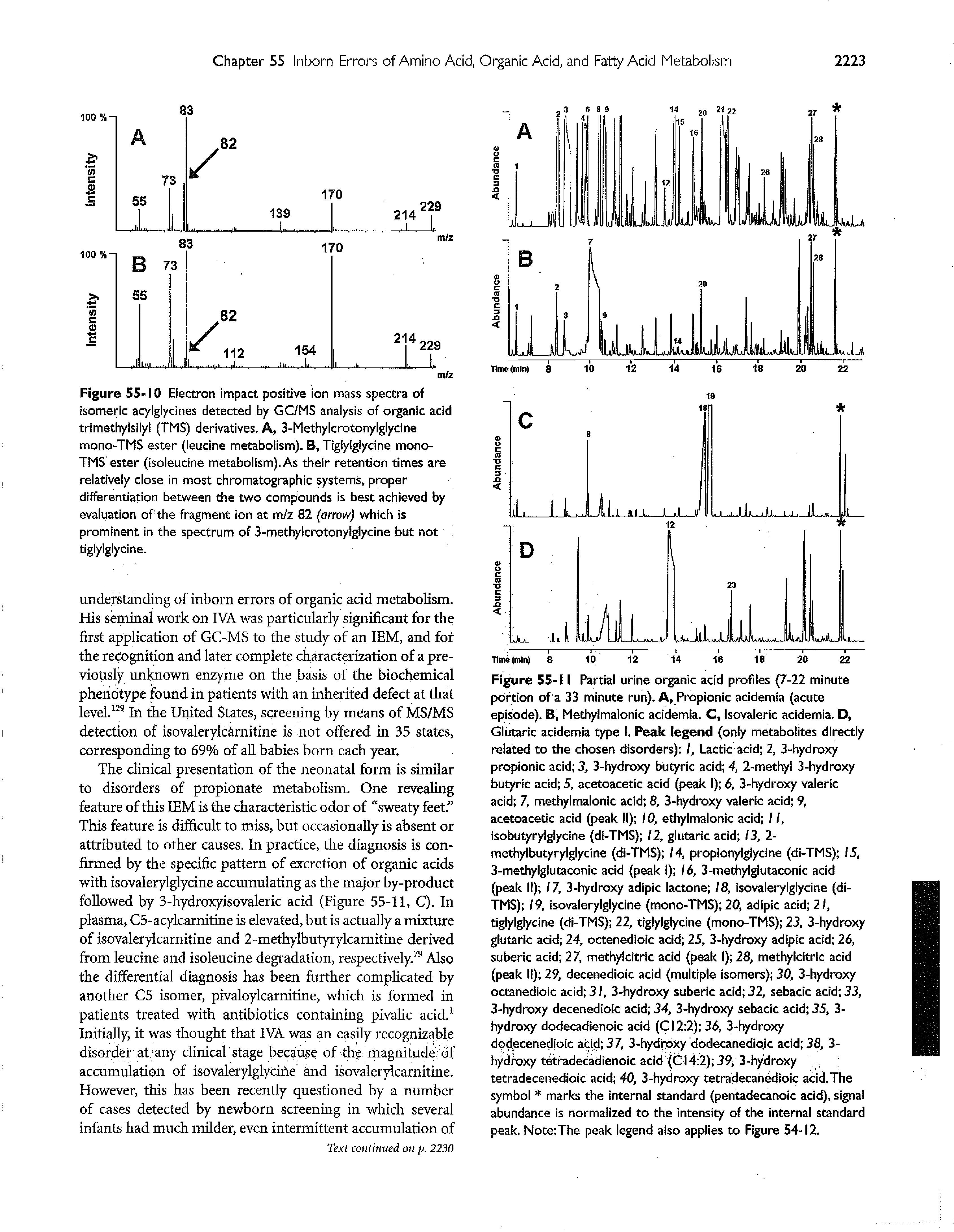 Figure 55-10 Electron impact positive ion mass spectra of isomeric acylglycines detected by GC/MS analysis of organic acid trimethyisily (IMS) derivatives. A, 3-liethylcrotonylglycine monO TMS ester (leucine metabolism). B, Tiglylglycine mono-TMS ester (isoleucine metabolism). As their retention times are relatively close in most chromatographic systems, proper differentiation betv een the two compounds is best achieved by evaluation of the fragment ion at m/z 82 (arrow) which is prominent in the spectrum of 3-methylcrotonylglydne but not tigiylgiycine.