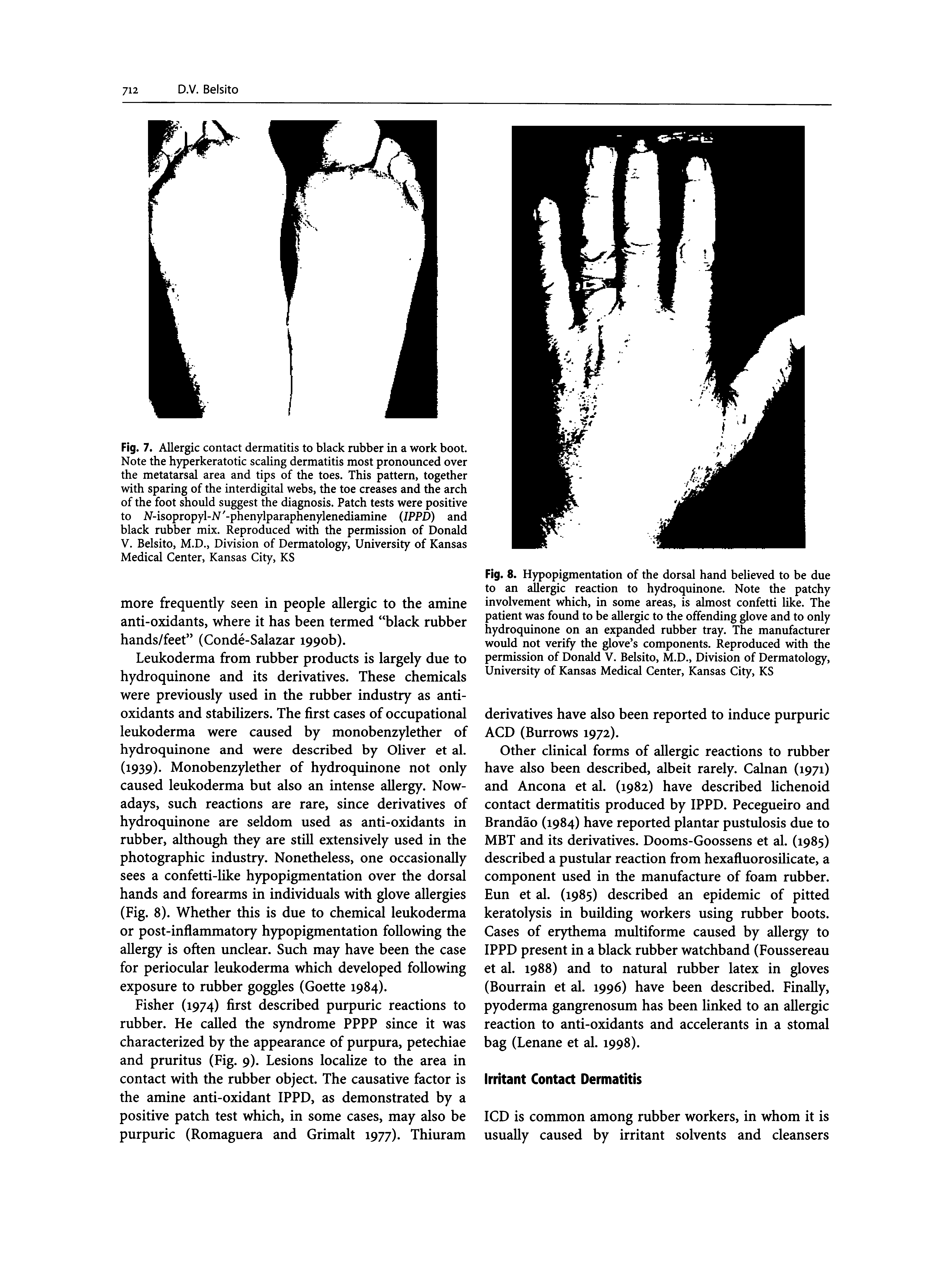 Fig. 8. Hypopigmentation of the dorsal hand believed to be due to an allergic reaction to hydroquinone. Note the patchy involvement which, in some areas, is almost confetti like. The patient was found to be allergic to the offending glove and to only hydroquinone on an expanded rubber tray. The manufacturer would not verify the glove s components. Reproduced with the permission of Donald V. Belsito, M.D., Division of Dermatology, University of Kansas Medical Center, Kansas City, KS...