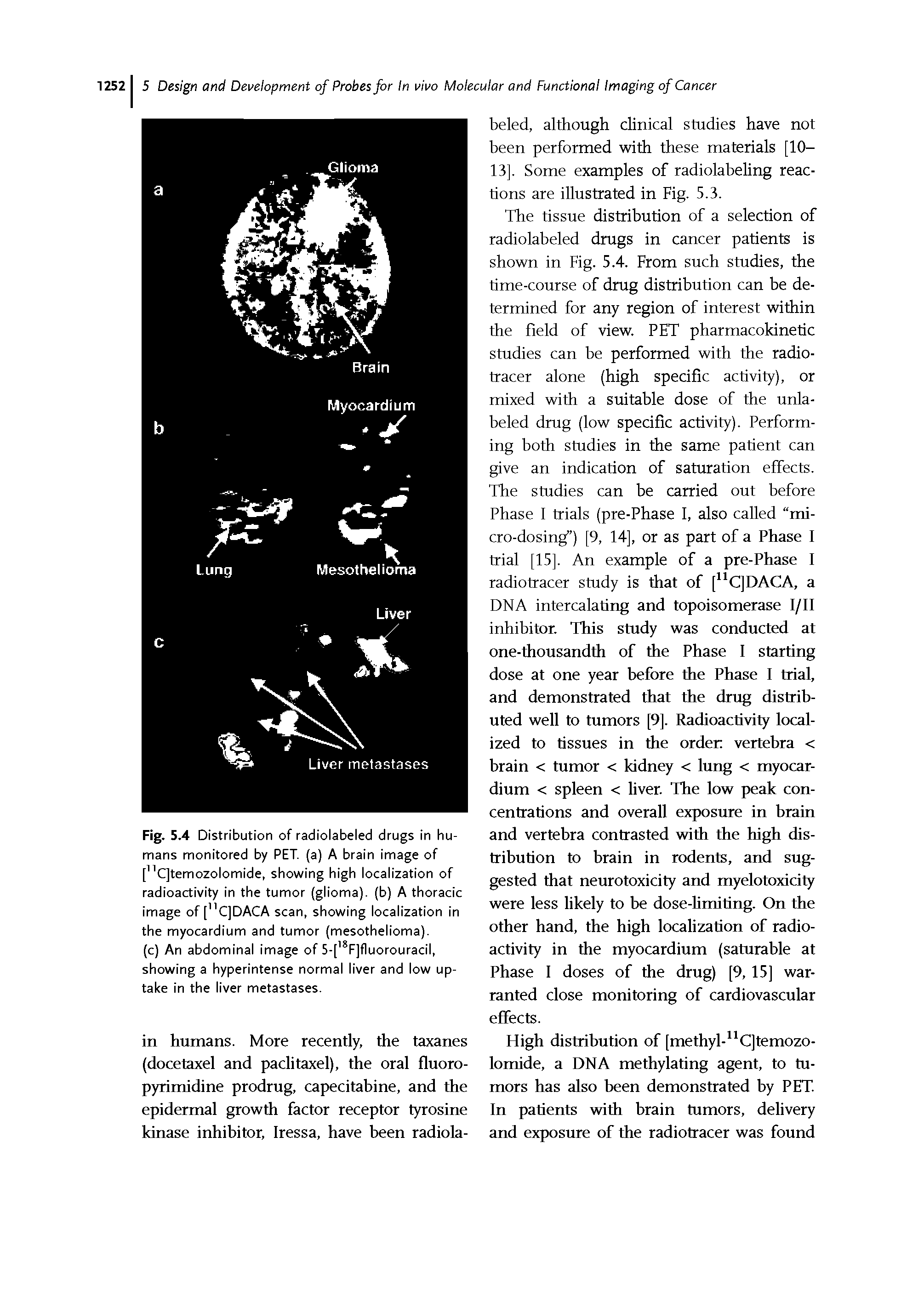 Fig. 5.4 Distribution of radiolabeled drugs in humans monitored by PET. (a) A brain image of ["CJtemozolomide, showing high localization of radioactivity in the tumor (glioma), (b) A thoracic image of [ C]DACA scan, showing localization in the myocardium and tumor (mesothelioma).
