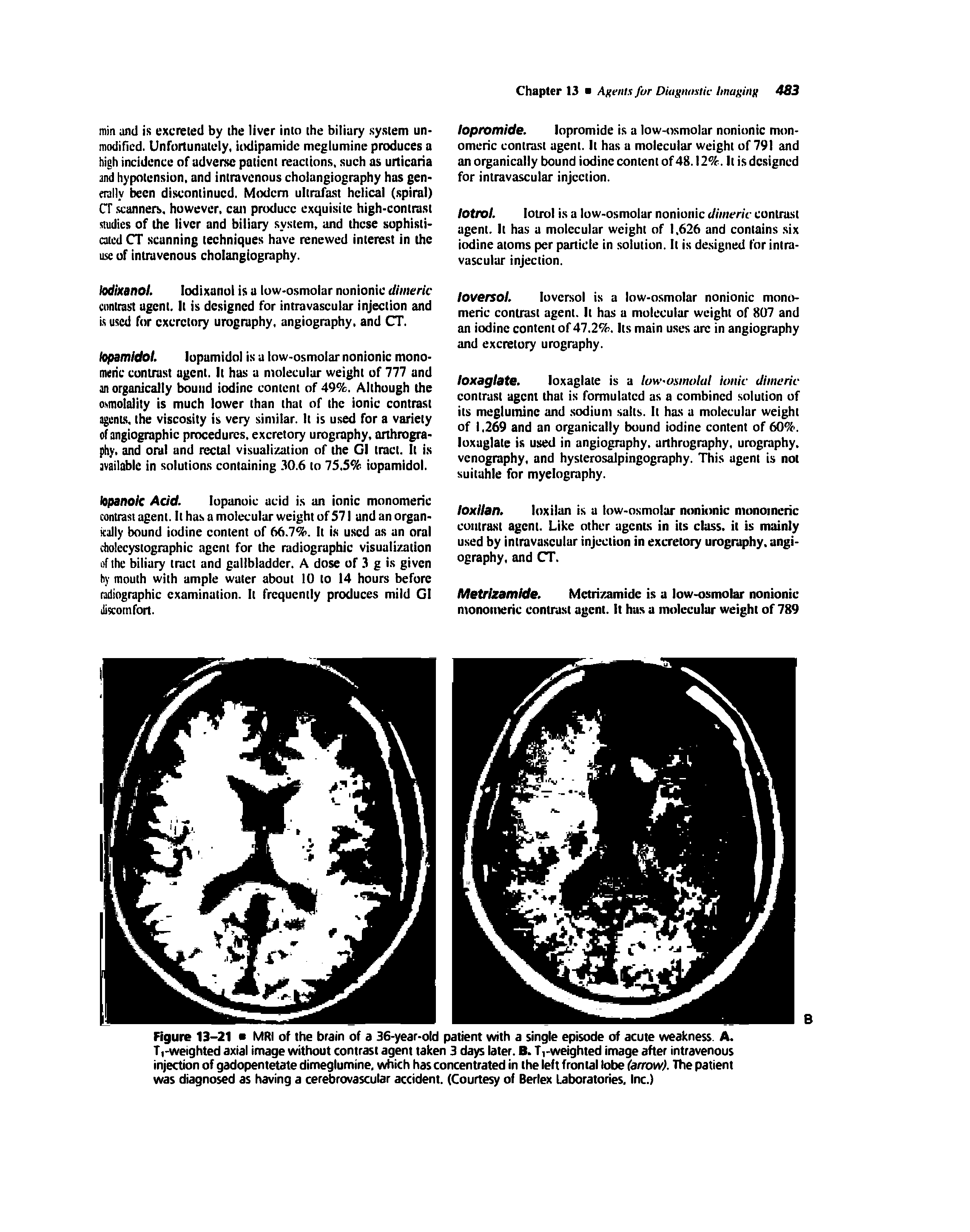 Figure 13-21 MRI of the brain of a 36-year-old patient with a single episode of acute weakness. A. T,-weighted axial image without contrast agent taken 3 days later. B. Ti-weighted image after intravenous injection of gadopentetate dimeglumine, which has concentrated in the left frontal lobe (arrow). The patient was diagnosed as having a cerebrovascular accident. (Courtesy of Berlex Laboratories. Inc.)...