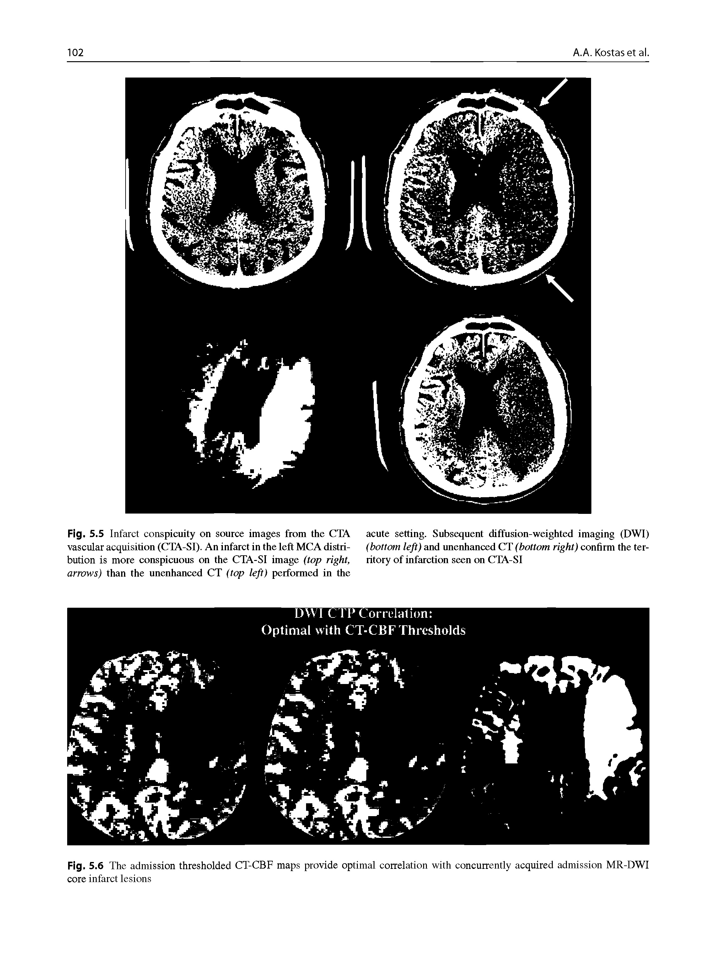 Fig. 5.6 The admission thresholded CT-CBF maps provide optimal correlation with concurrently acquired admission MR-DWI core infarct lesions...