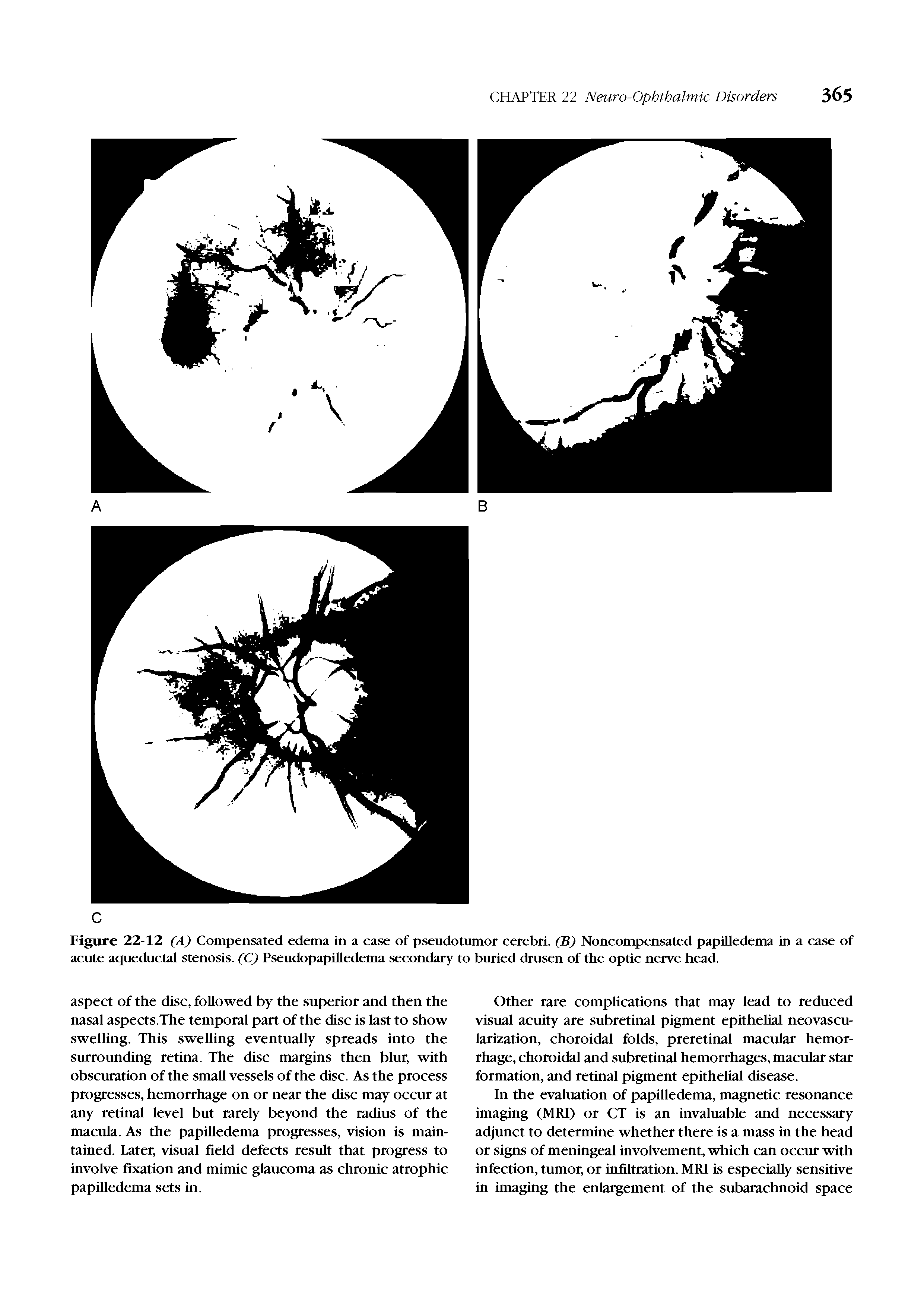 Figure 22-12 (A) Compensated edema in a case of pseudotumor cerebri. (B) Noncompensated papilledema in a case of acute aqueductal stenosis. (C) PseudopapUledema secondary to buried drusen of the optic nerve head.