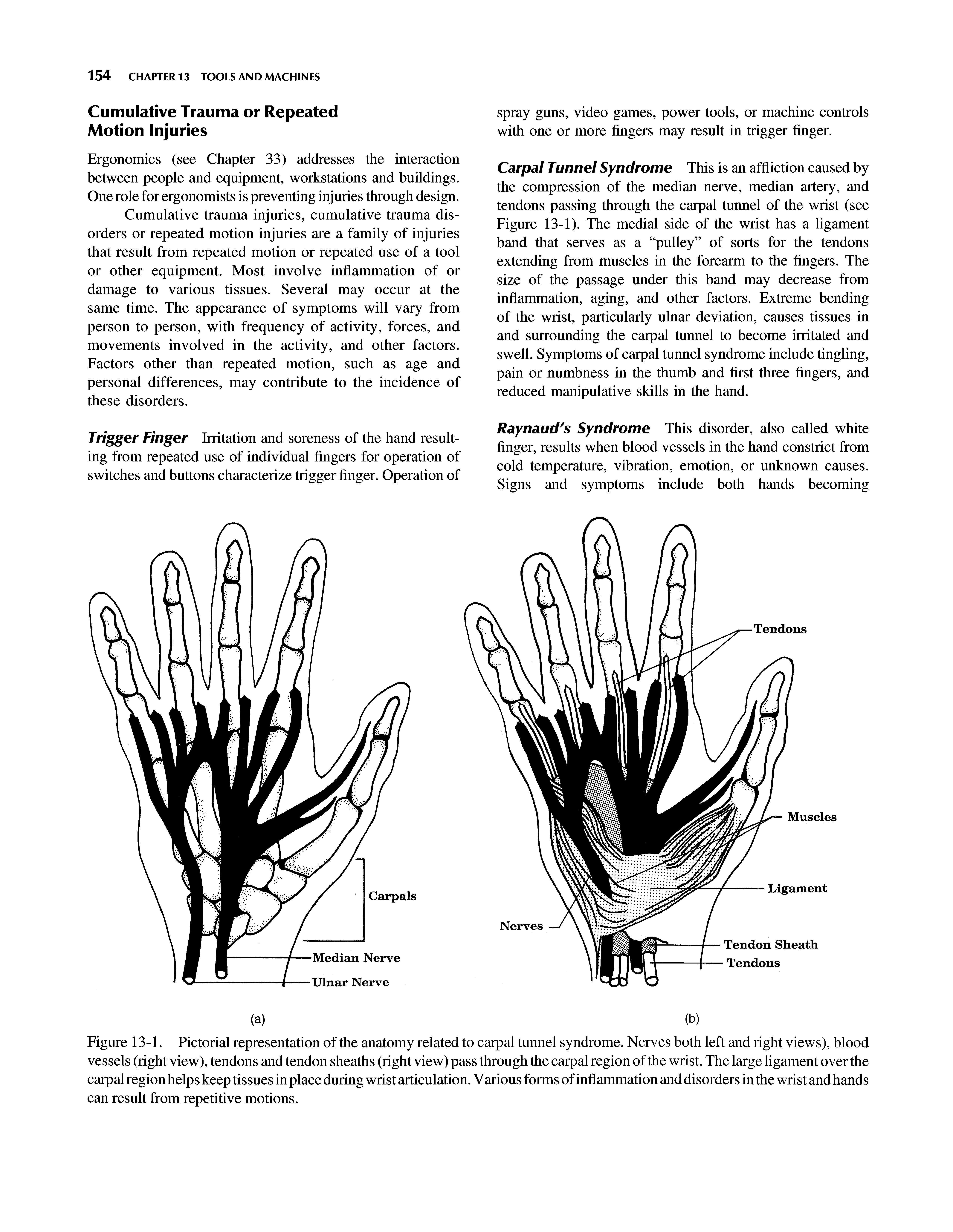 Figure 13-1. Pictorial representation of the anatomy related to carpal tunnel syndrome. Nerves both left and right views), blood vessels (right view), tendons and tendon sheaths (right view) pass through the carpal region of the wrist. The large ligament over the carpal region helps keep tissues in place during wrist articulation. V arious forms of inflammation and disorders in the wrist and hands can result from repetitive motions.