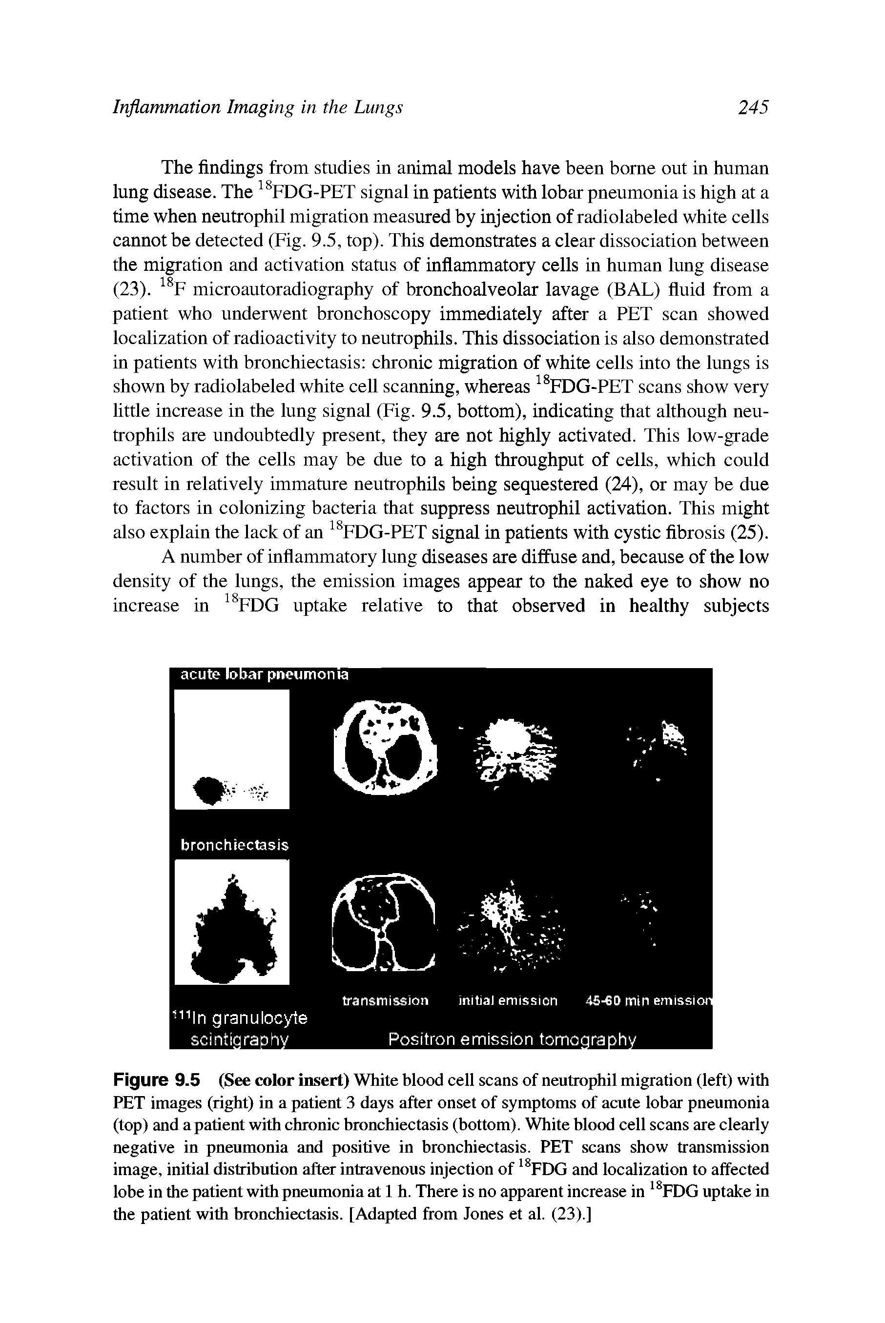 Figure 9.5 (See color insert) White blood cell scans of neutrophil migration (left) with PET images (right) in a patient 3 days after onset of symptoms of acute lobar pneumonia (top) and a patient with chronic bronchiectasis (bottom). White blood cell scans are clearly negative in pneumonia and positive in bronchiectasis. PET scans show transmission image, initial distribution after intravenous injection of FDG and localization to affected lobe in the patient with pneumonia at 1 h. There is no apparent increase in FDG uptake in the patient with bronchiectasis. [Adapted from Jones et al. (23).]...