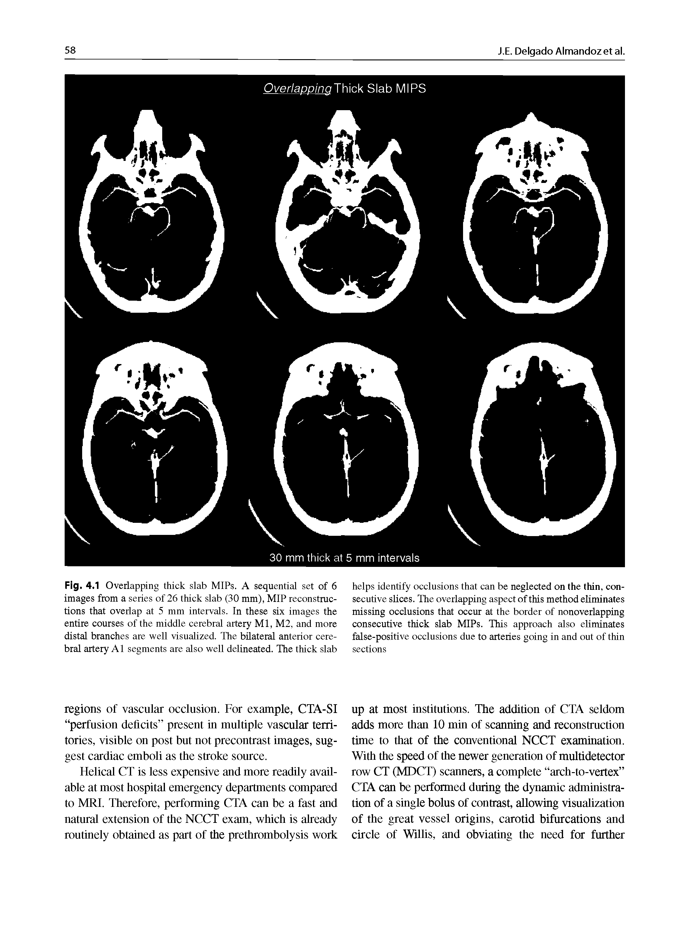 Fig. 4.1 Overlapping thick slab MlPs. A sequential set of 6 images from a series of 26 thick slab (30 mm), MIP reconstructions that overlap at 5 mm intervals, in these six images the entire courses of the middle cerebral artery Ml, M2, and more distal branches are well visualized. The bilateral anterior cerebral artery Al segments are also well delineated. The thick slab...