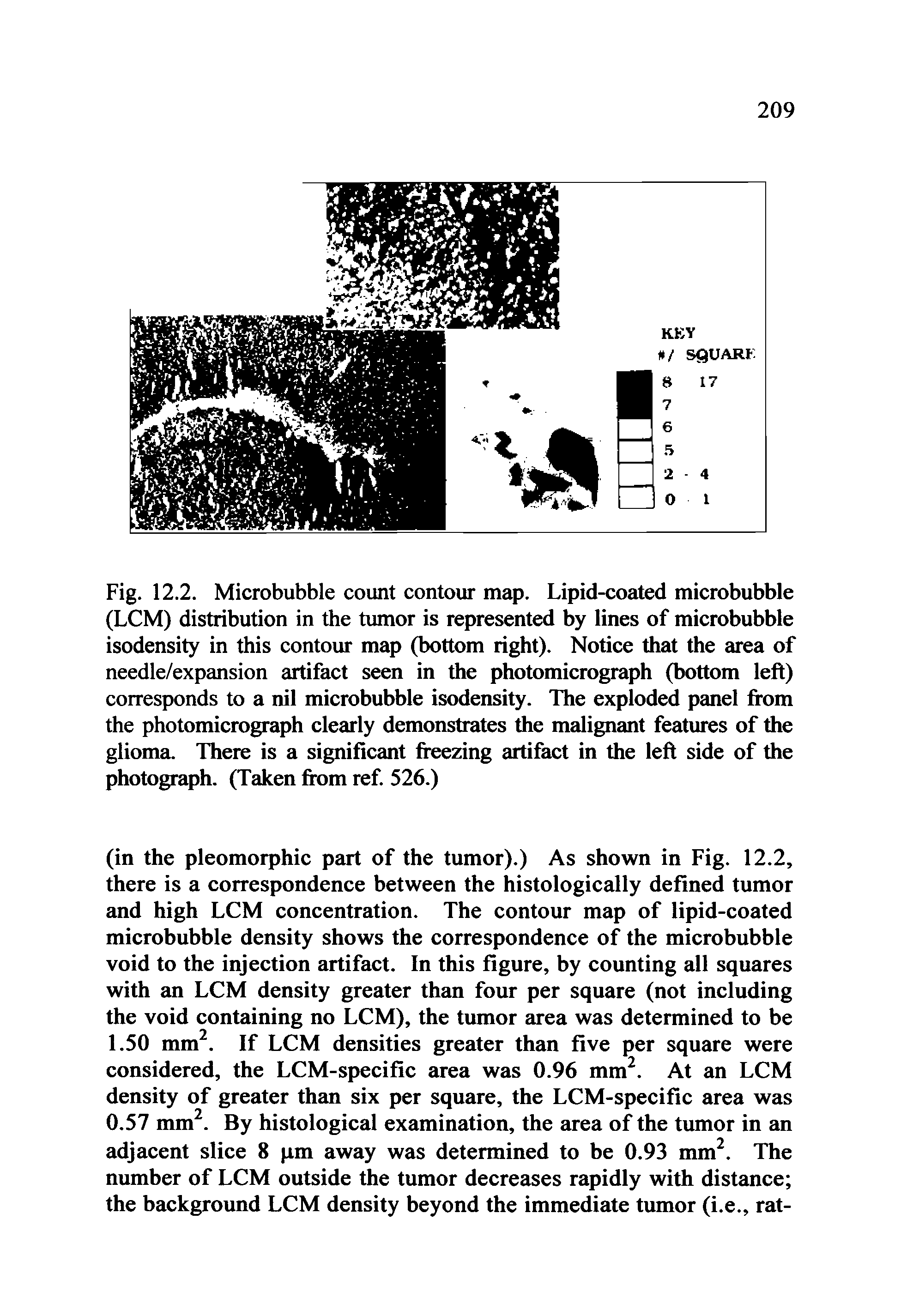 Fig. 12.2. Microbubble count contour map. Lipid-coated microbubble (LCM) distribution in the tumor is represented by lines of microbubble isodensity in this contour map (bottom right). Notice that the area of needle/expansion artifact seen in the photomicrograph (bottom left) corresponds to a nil microbubble isodensity. The exploded panel from the photomicrograph clearly demonstrates the malignant features of the glioma. There is a significant freezing artifact in the left side of the photograph. (Taken from ref. 526.)...