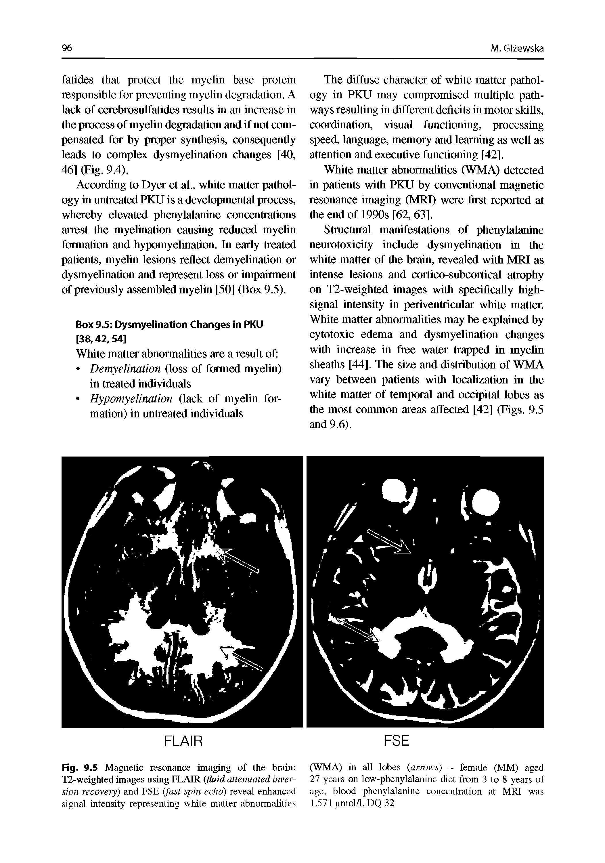 Fig. 9.5 Magnetic resonance imaging of the brain T2-weighted images using FLAIR (fluid attenuated inversion recovery) and FSE (fast spin echo) reveal enhanced signal intensity representing white matter abnormalities...