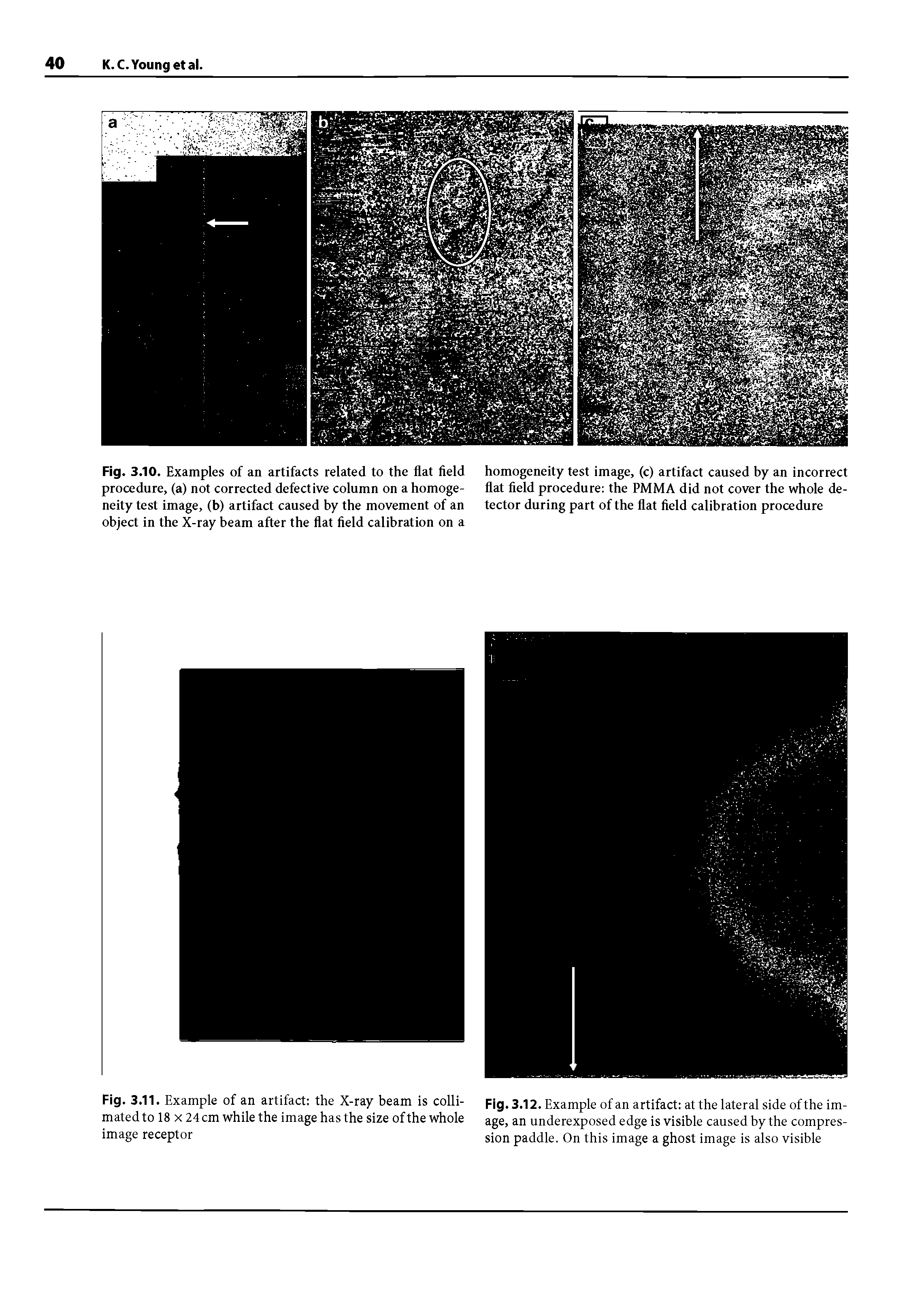 Fig. 3.12. Example of an artifact at the lateral side of the image, an underexposed edge is visible caused by the compression paddle. On this image a ghost image is also visible...