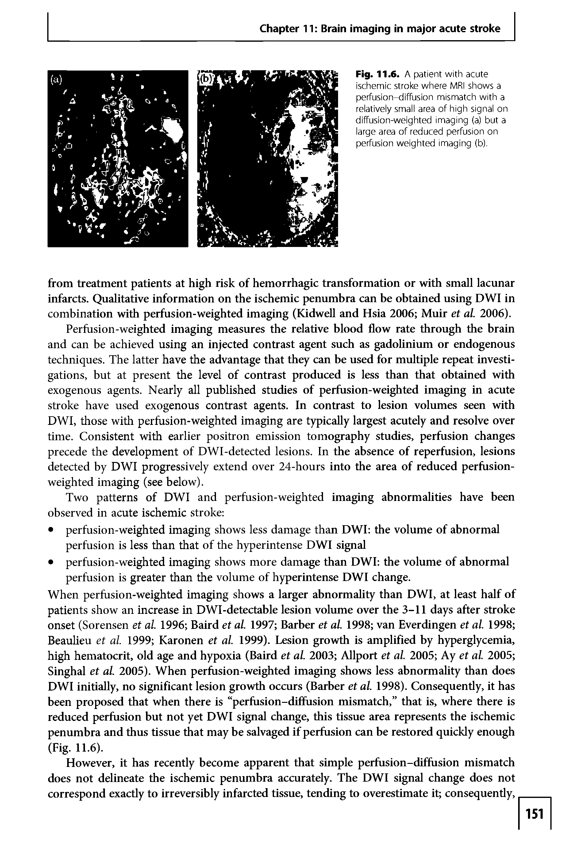 Fig. 11.6. A patient with acute ischemic stroke where MRI shows a perfusion-diffusion mismatch with a relatively small area of high signal on diffusion-weighted imaging (a) but a large area of reduced perfusion on perfusion weighted imaging (b).