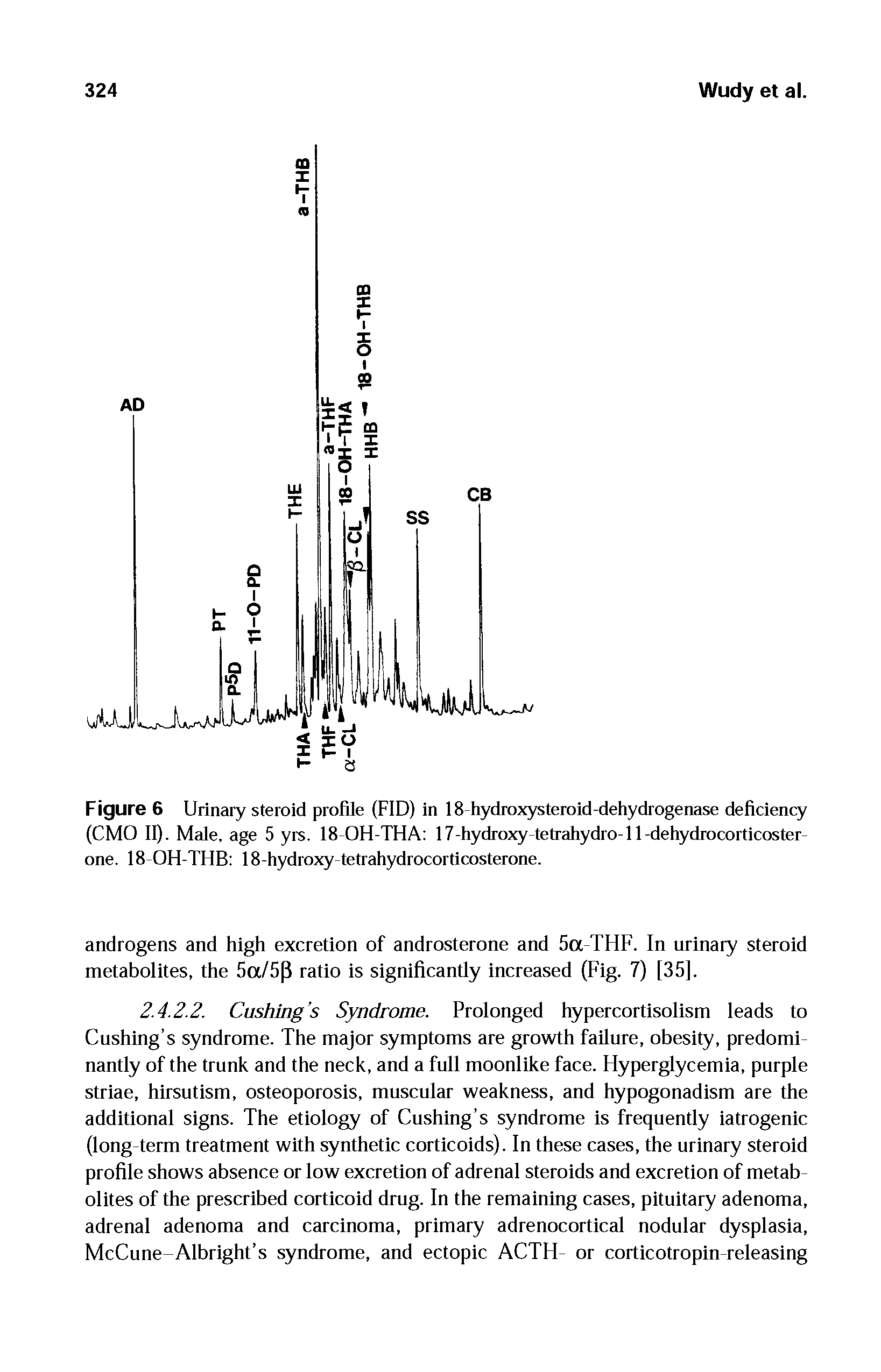Figure 6 Urinary steroid profile (FID) in 18-hydroxysteroid-dehydrogenase deficiency (CMO II). Male, age 5 yrs. 18-OH-THA 17-hydroxy tetrahydro-11-dehydrocorticosterone. 18 OH-THB 18-hydroxy-tetrahydrocorticosterone.