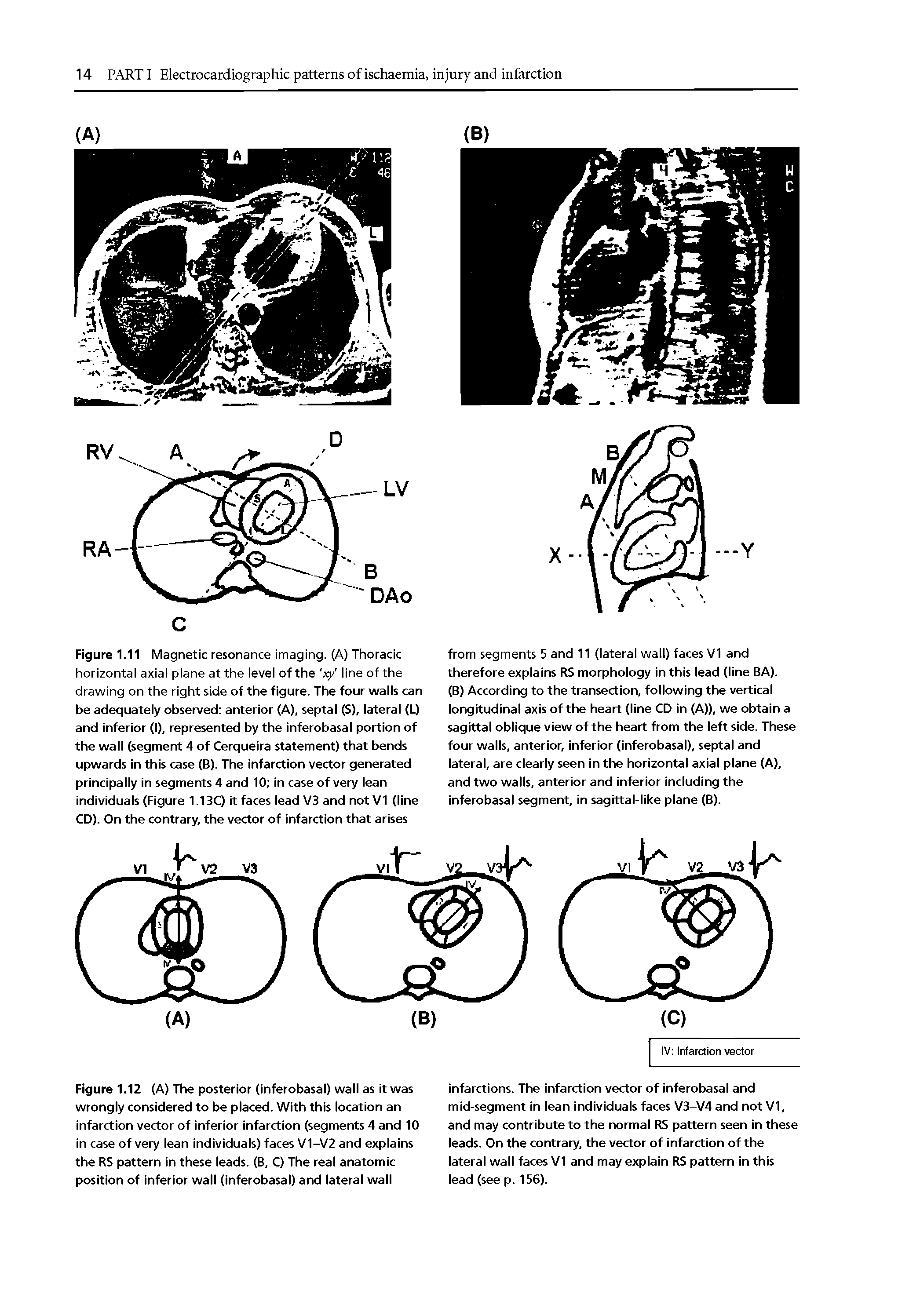 Figure 1.12 (A) The posterior (inferobasal) wall as it was wrongly considered to be placed. With this location an infarction vector of inferior infarction (segments 4 and 10 in case of very lean individuals) faces V1-V2 and explains the RS pattern in these leads. (B, C) The real anatomic position of inferior wall (inferobasal) and lateral wall...