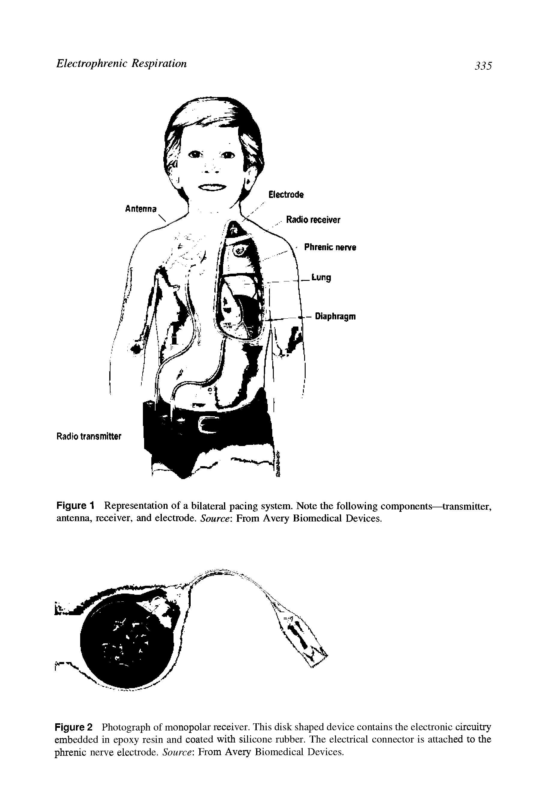 Figure 1 Representation of a bilateral pacing system. Note the following components—transmitter, antenna, receiver, and electrode. Source From Avery Biomedical Devices.