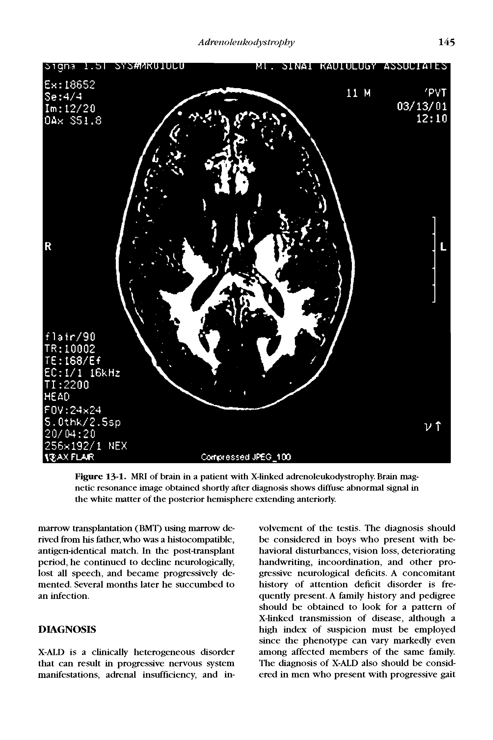 Figure 13-1. MRI of brain in a patient with X-Iinked adrenoleukodystrophy. Brain magnetic resonance image obtained shortly after diagnosis shows diffuse abnormal signal in the white matter of the posterior hemisphere extending anteriorly.