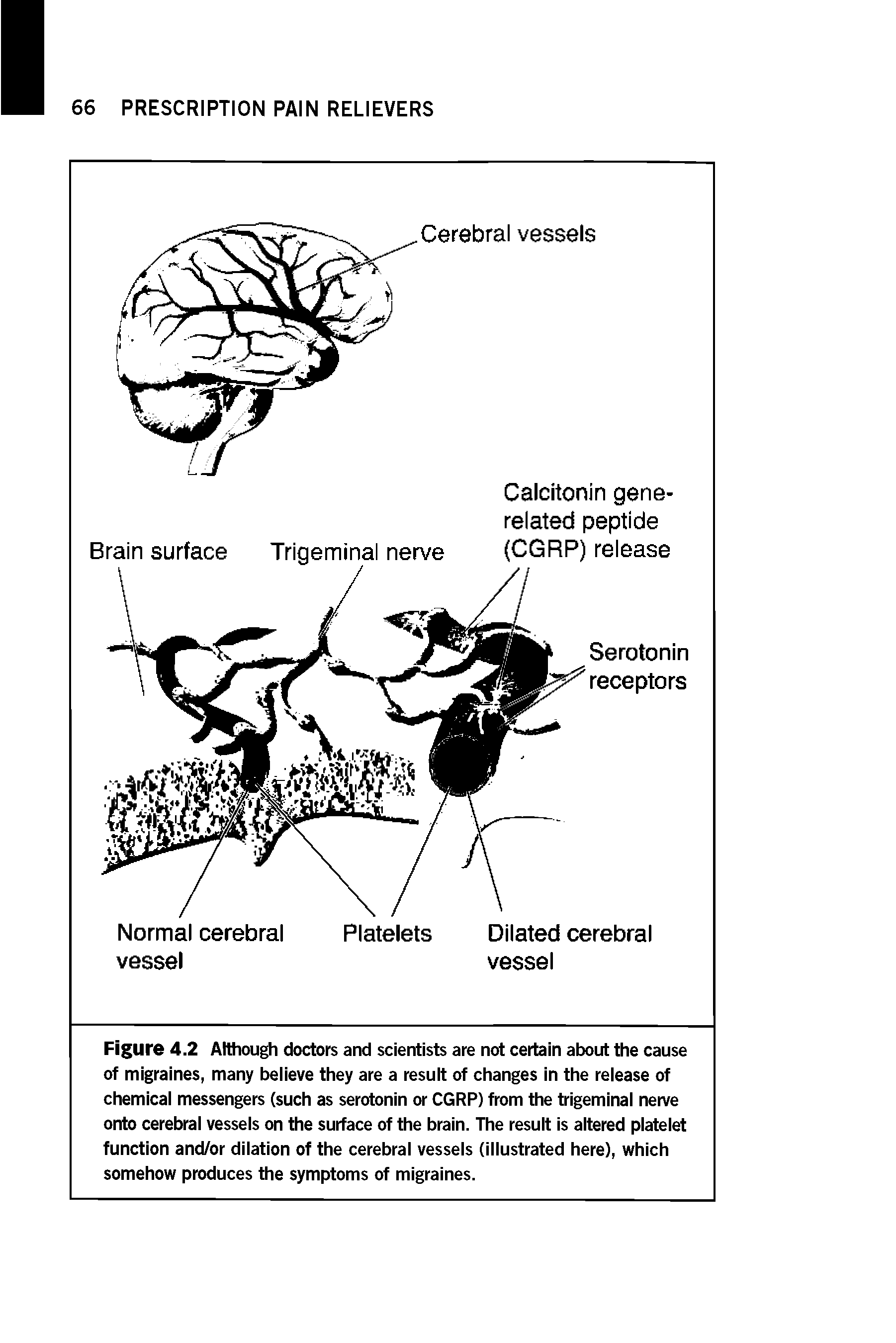 Figure 4.2 Although doctors and scientists are not certain about the cause of migraines, many believe they are a result of changes in the release of chemical messengers (such as serotonin or CGRP) from the trigeminal nerve onto cerebral vessels on the surface of the brain. The result is altered platelet function and/or dilation of the cerebral vessels (illustrated here), which somehow produces the symptoms of migraines.