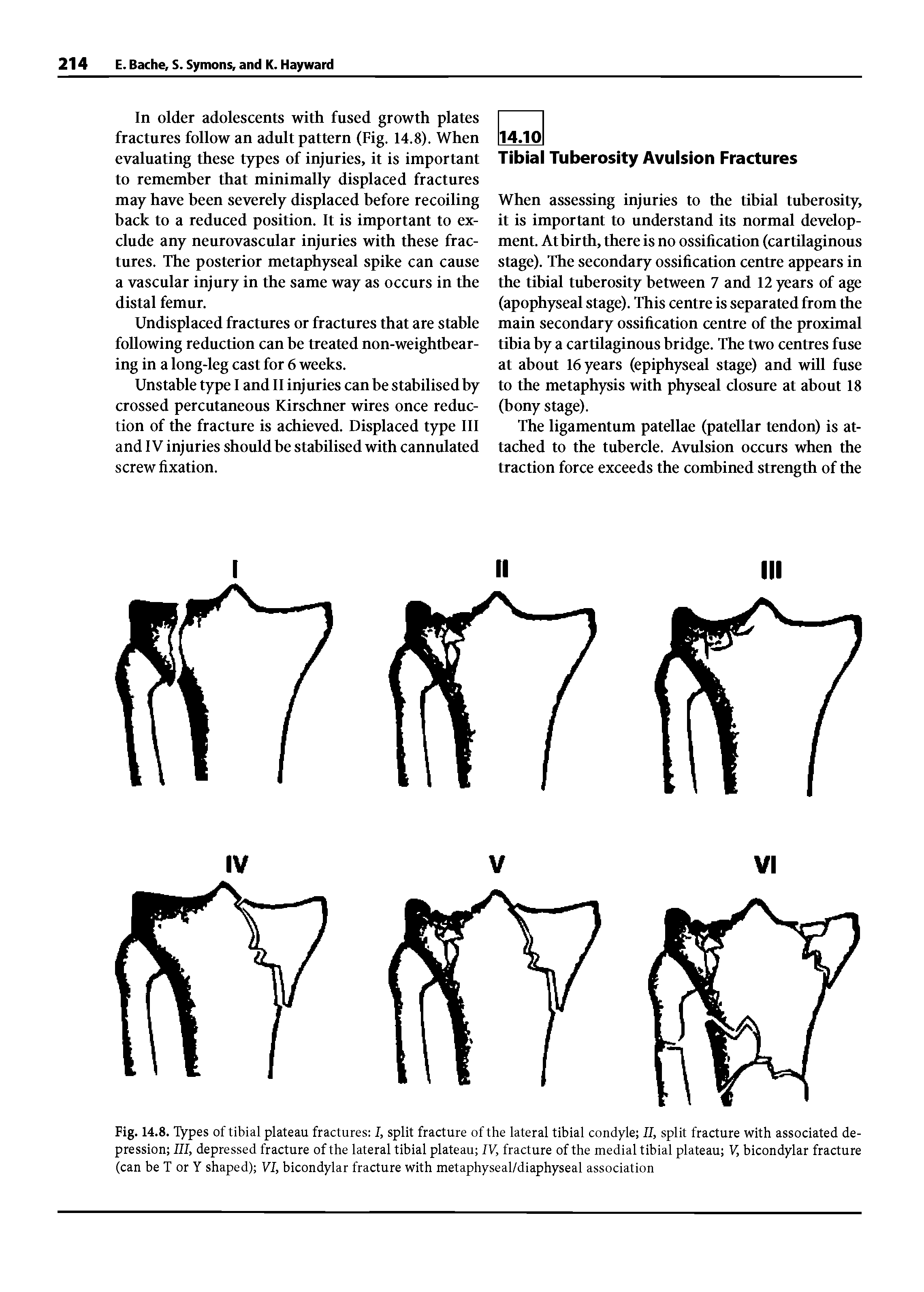 Fig. 14.8. Types of tibial plateau fractures I, split fracture of the lateral tibial condyle II, split fracture with associated depression III, depressed fracture of the lateral tibial plateau IV, fracture of the medial tibial plateau V, bicondylar fracture (can be T or Y shaped) VI, bicondylar fracture with metaphyseal/diaphyseal association...