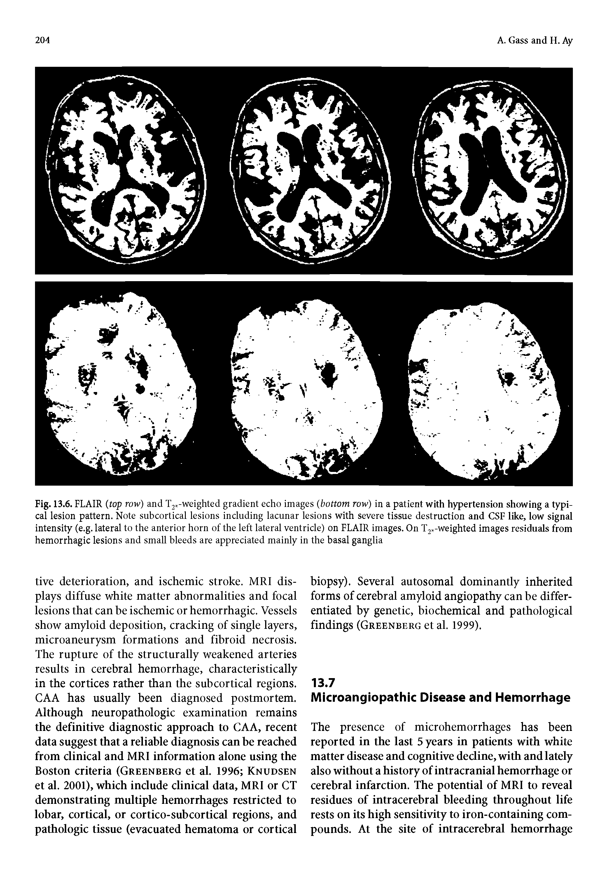 Fig. 13.6. FLAIR (top row) and T2 -weighted gradient echo images (bottom row) in a patient with hypertension showing a typical lesion pattern. Note subcortical lesions including lacunar lesions with severe tissue destruction and CSF like, low signal intensity (e.g. lateral to the anterior horn of the left lateral ventricle) on FLAIR images. On T2 -weighted images residuals from hemorrhagic lesions and small bleeds are appreciated mainly in the basal ganglia...